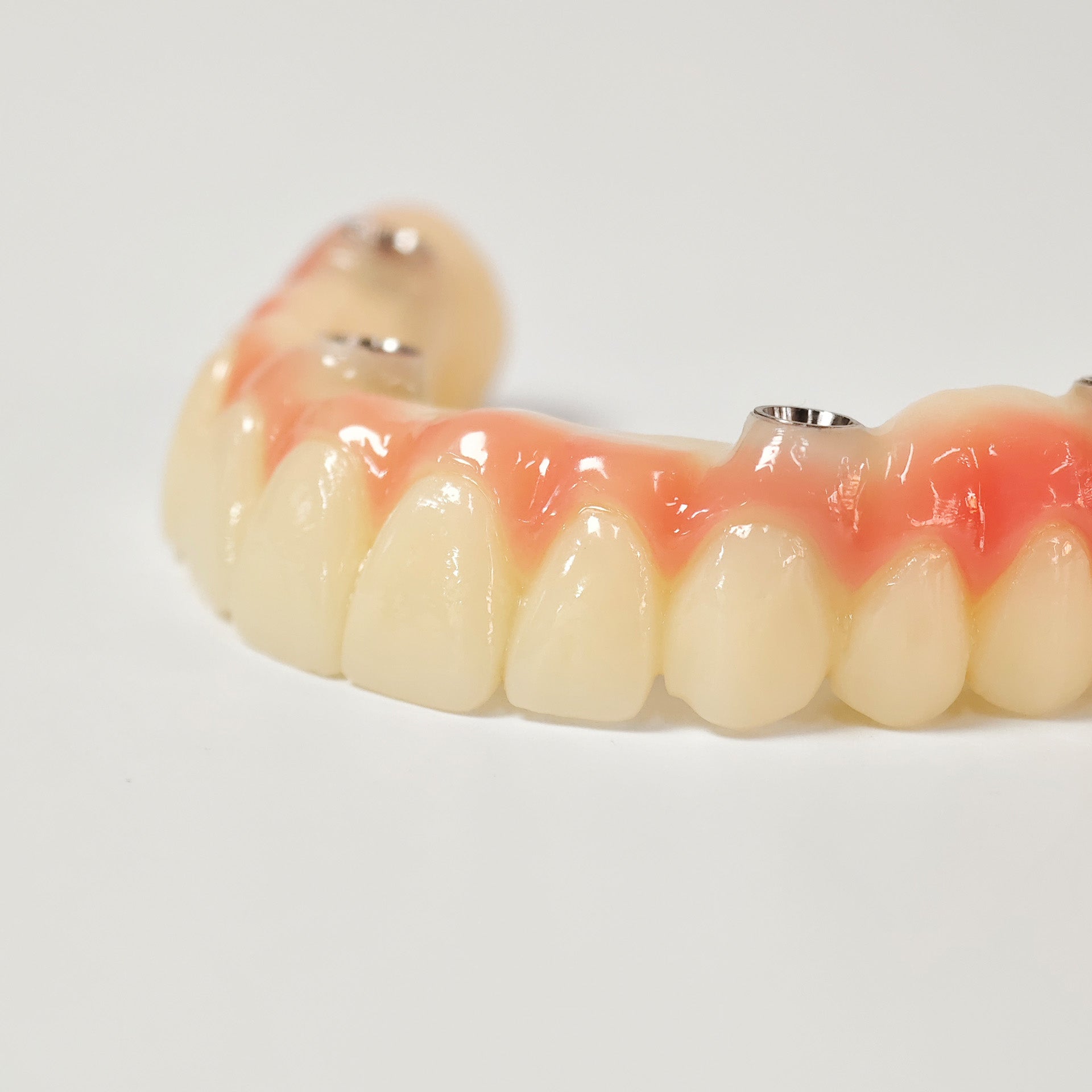 PMMA Bridge With Screw Retained