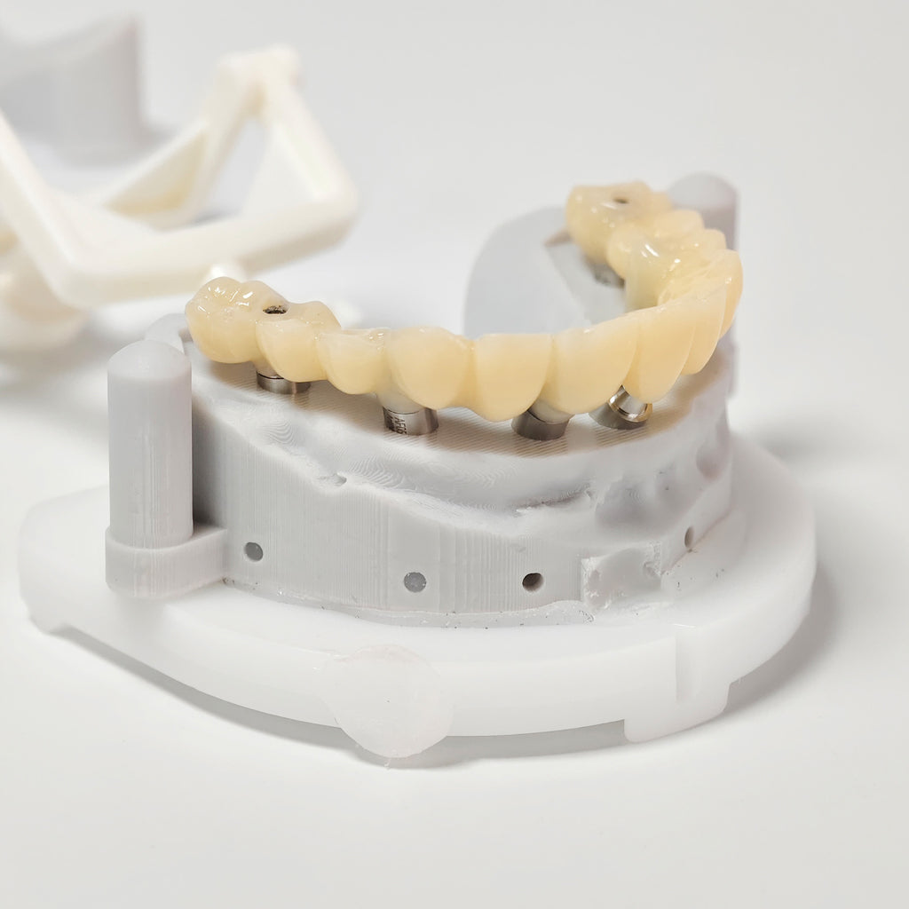 PMMA Bridge With Screw Retained