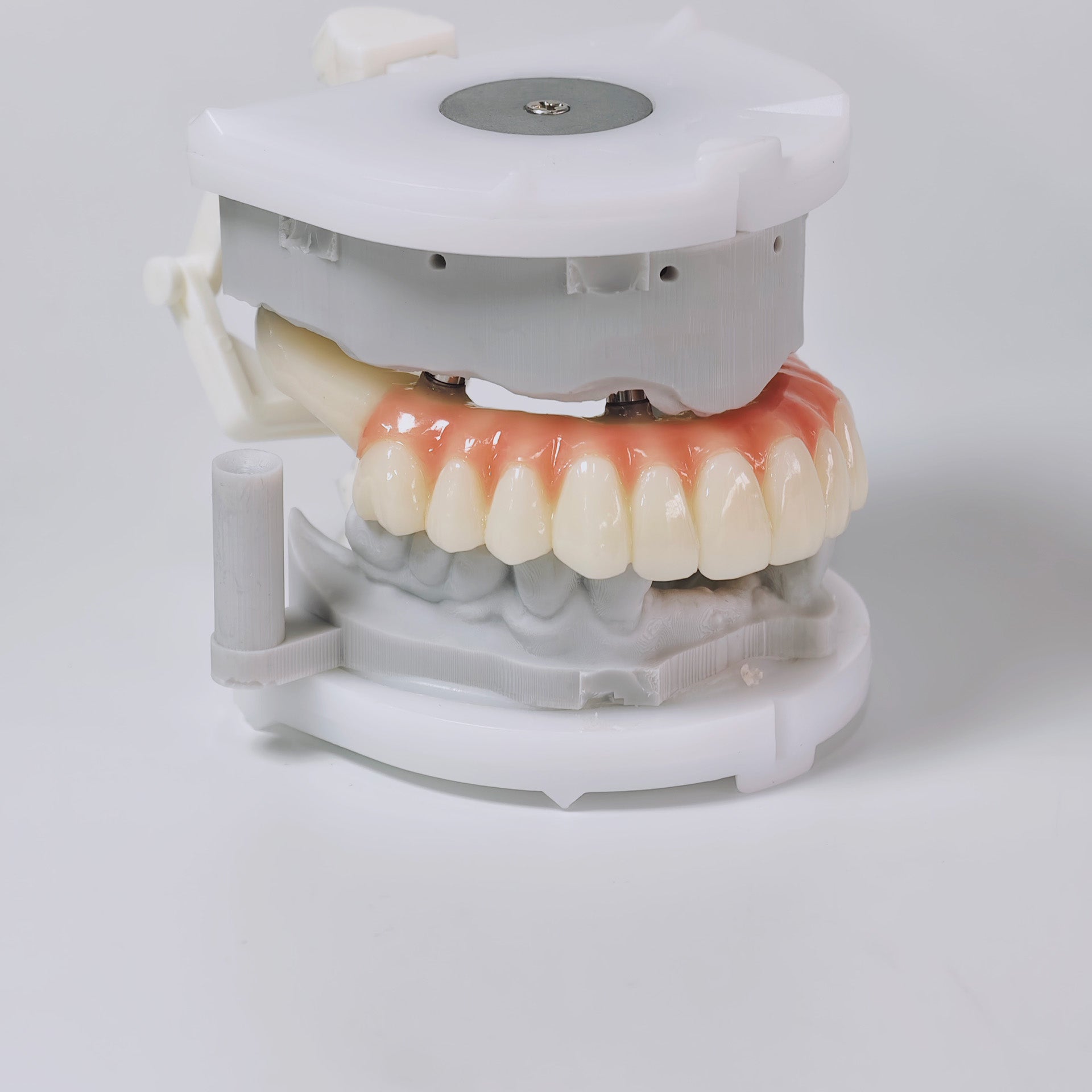 PMMA Bridge With Screw Retained