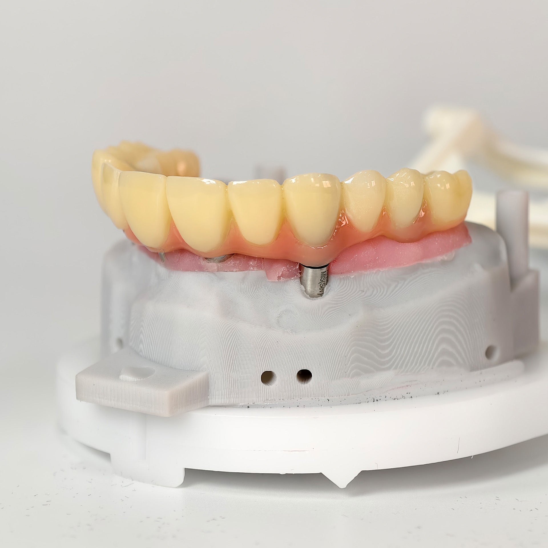 PMMA Bridge With Screw Retained