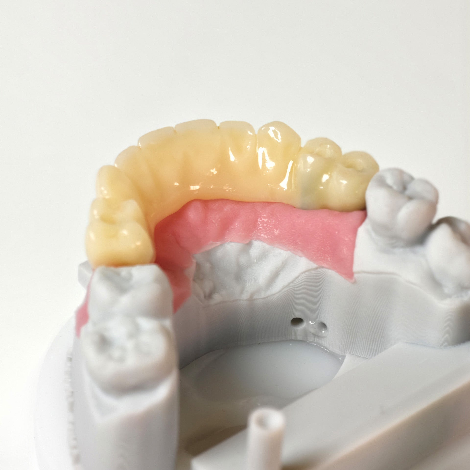 PMMA Bridge With Screw Retained