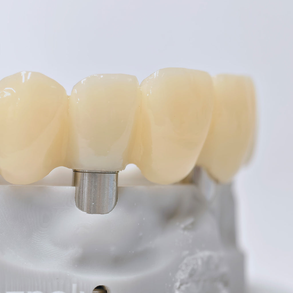 PMMA Bridge With Screw Retained
