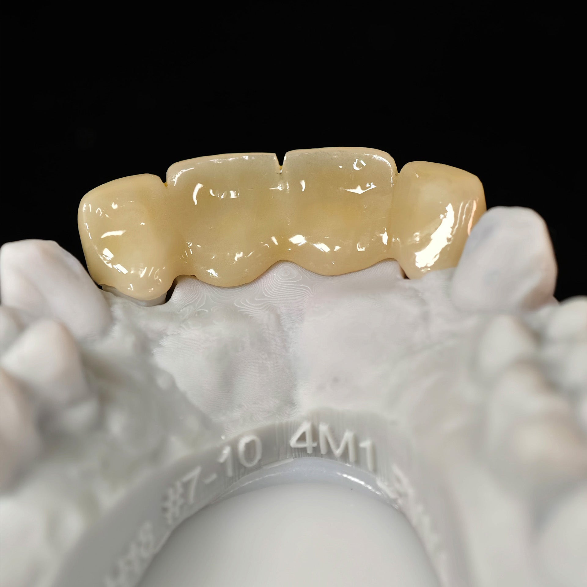 Pmma Bridge With Cement Retained