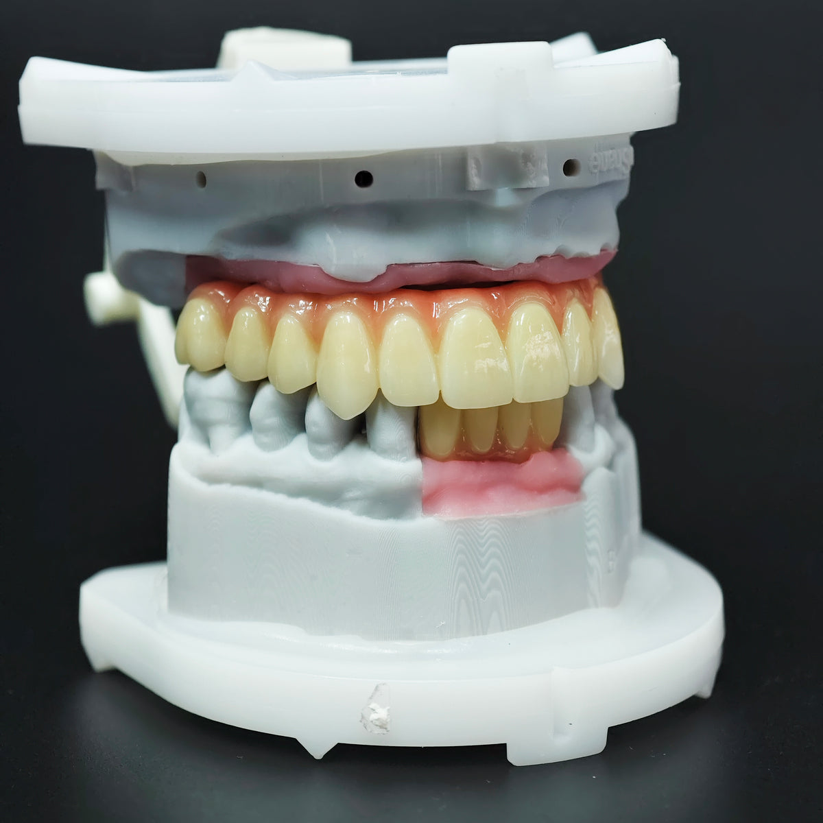 Ti-Bar Titanium Nitride Metal Frame With Zirconia Bridge For Full Arch Restoration