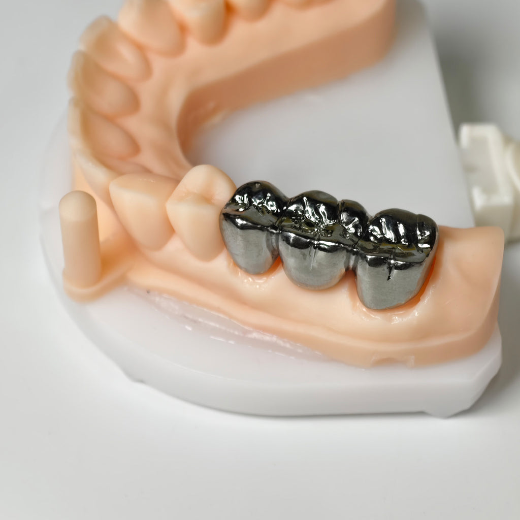 Titanium Crown With Cement Retained