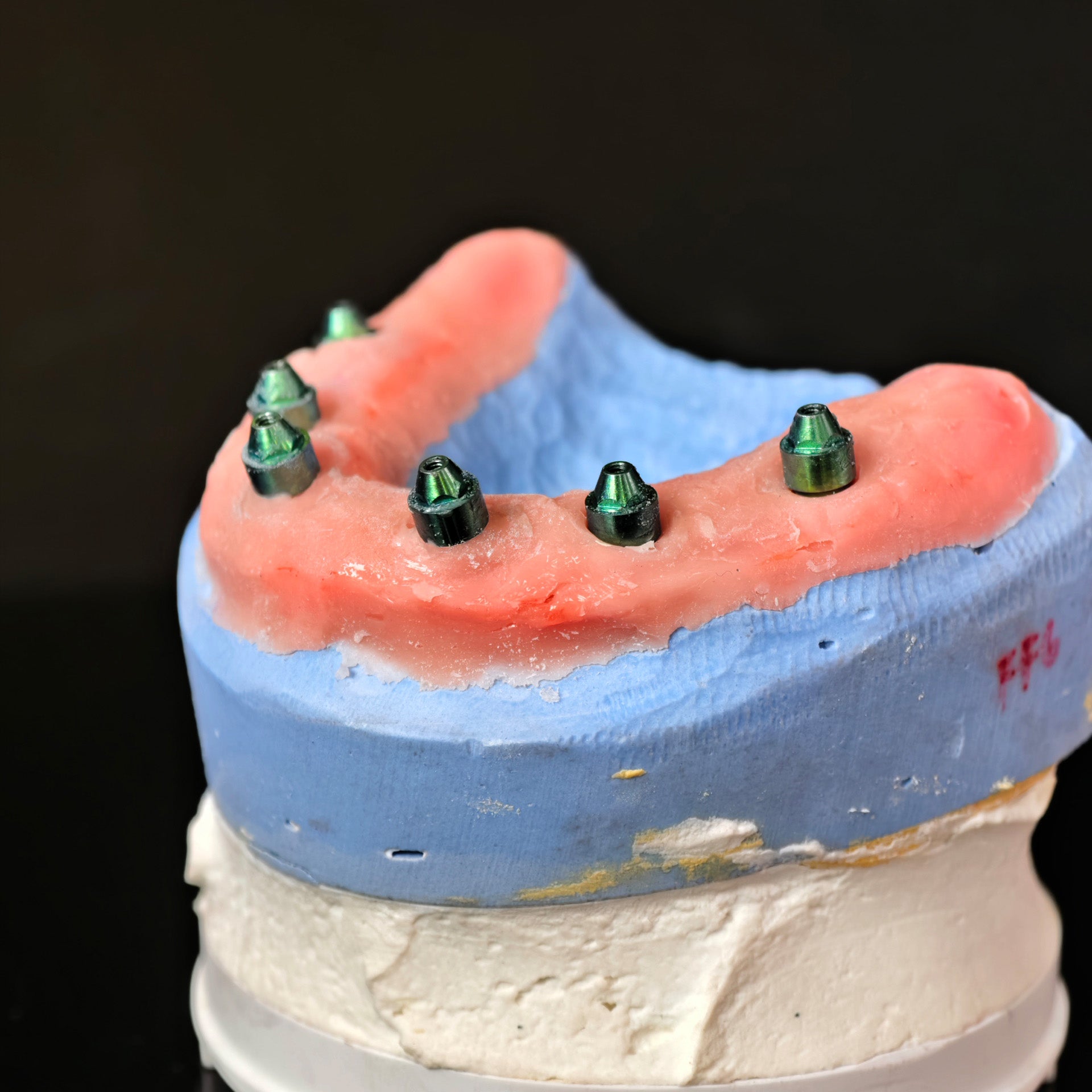 Traditional Malo Bridge With Alloy Framework Covering The Gingiva