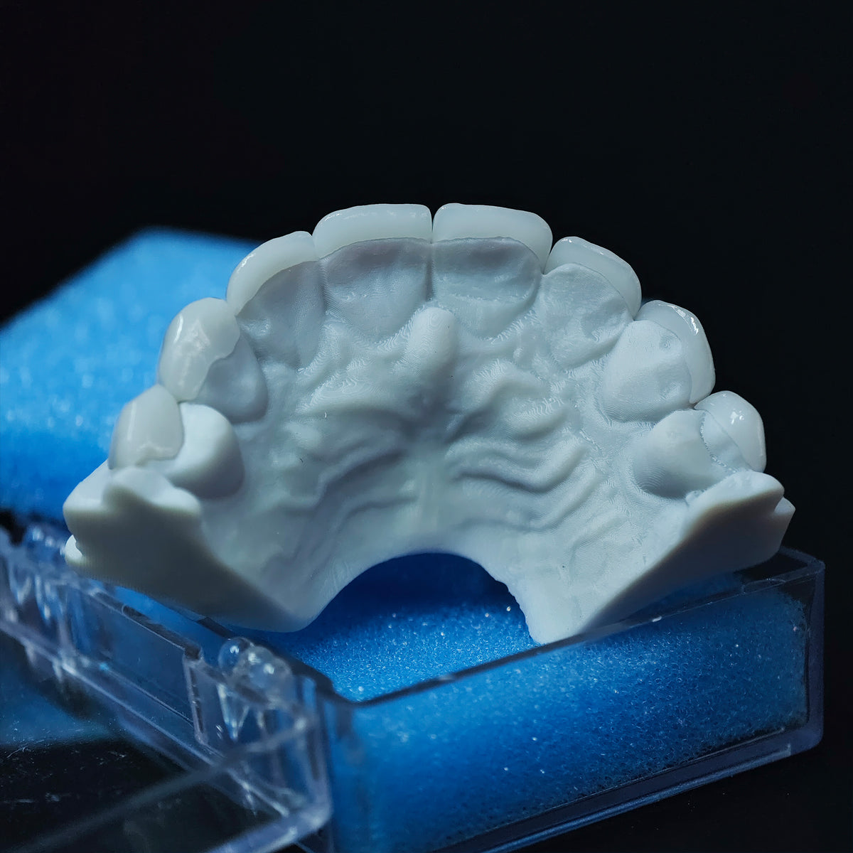 Ultra-Thin Emax Veneer. High Transparency/Translucent, Natural Shade