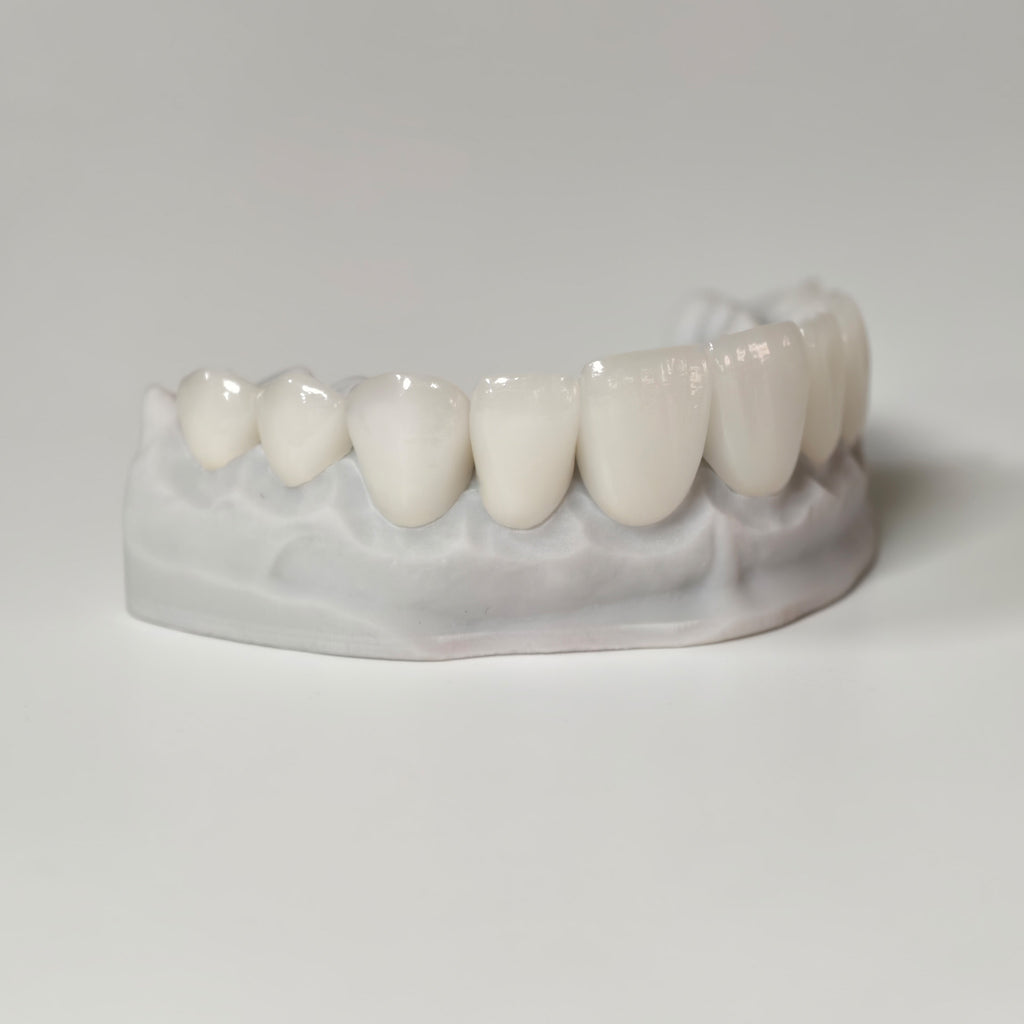 Ultra-Thin Emax Veneer. High Transparency/Translucent, Natural Shade