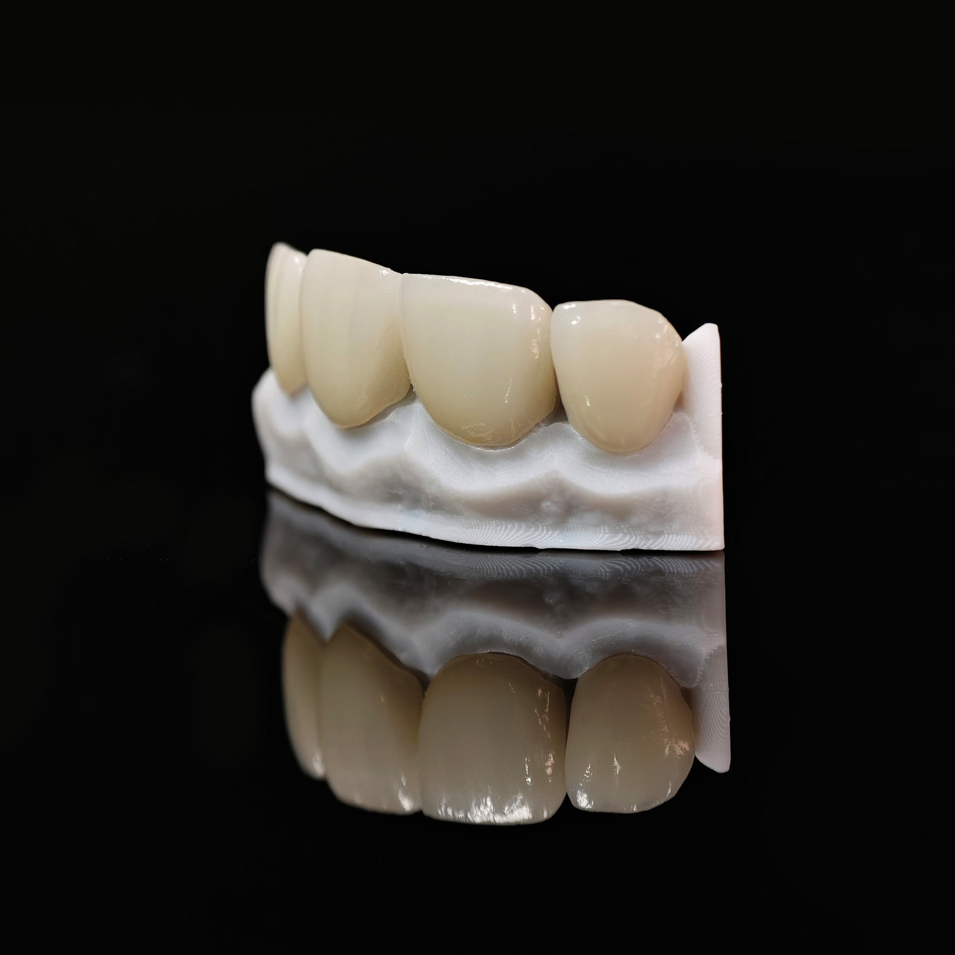 Ultra-Thin Emax Veneer. High Transparency/Translucent, Natural Shade