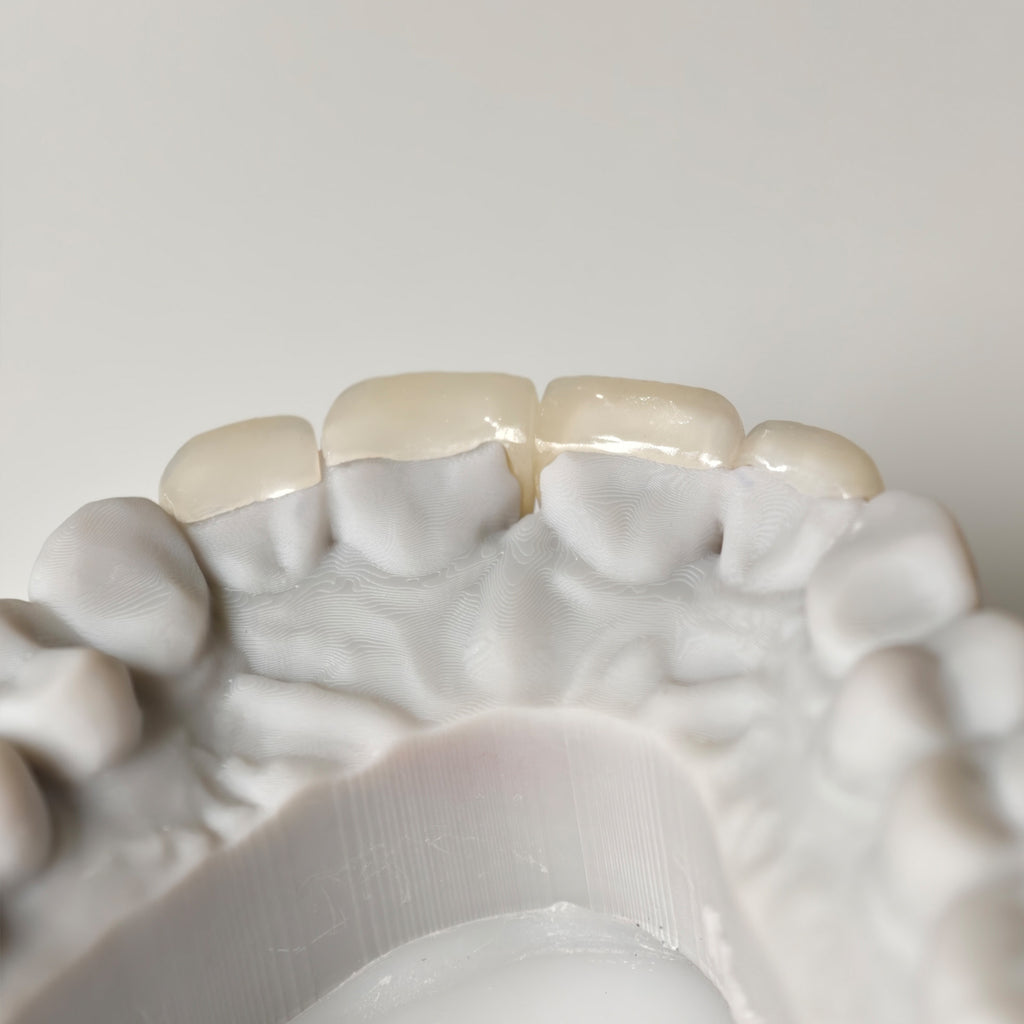 Ultra-Thin Emax Veneer. High Transparency/Translucent, Natural Shade