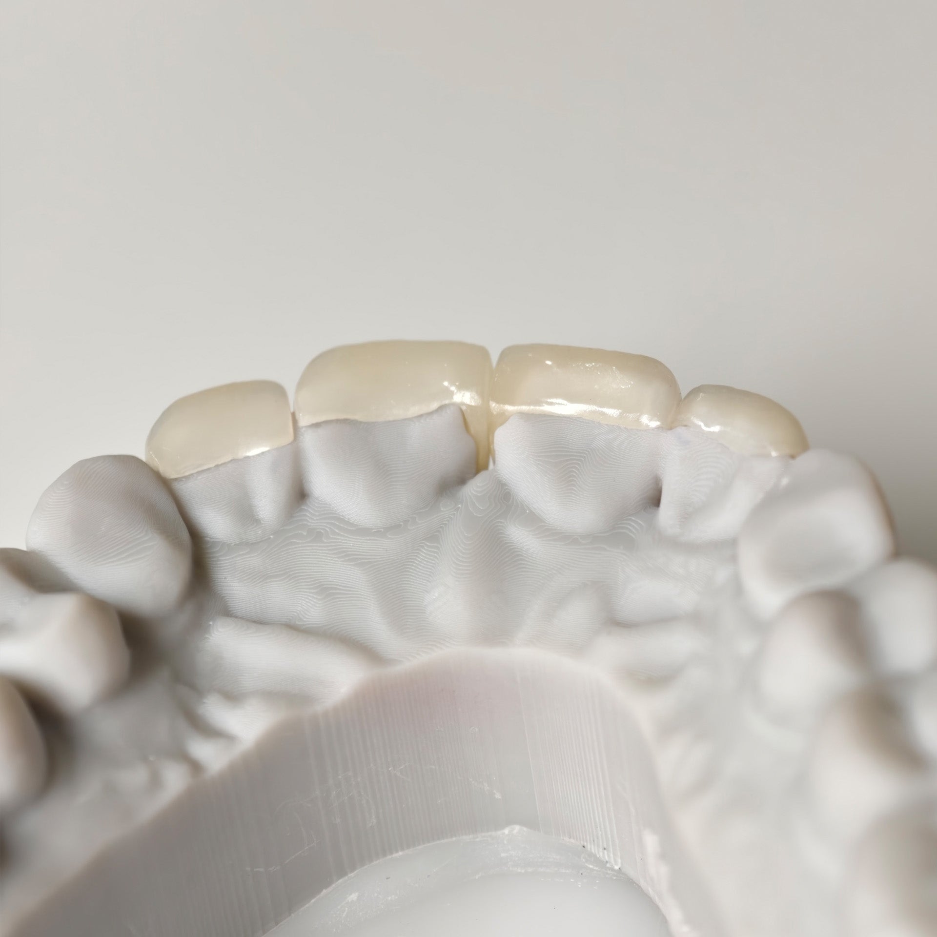 Ultra-Thin Emax Veneer. High Transparency/Translucent, Natural Shade