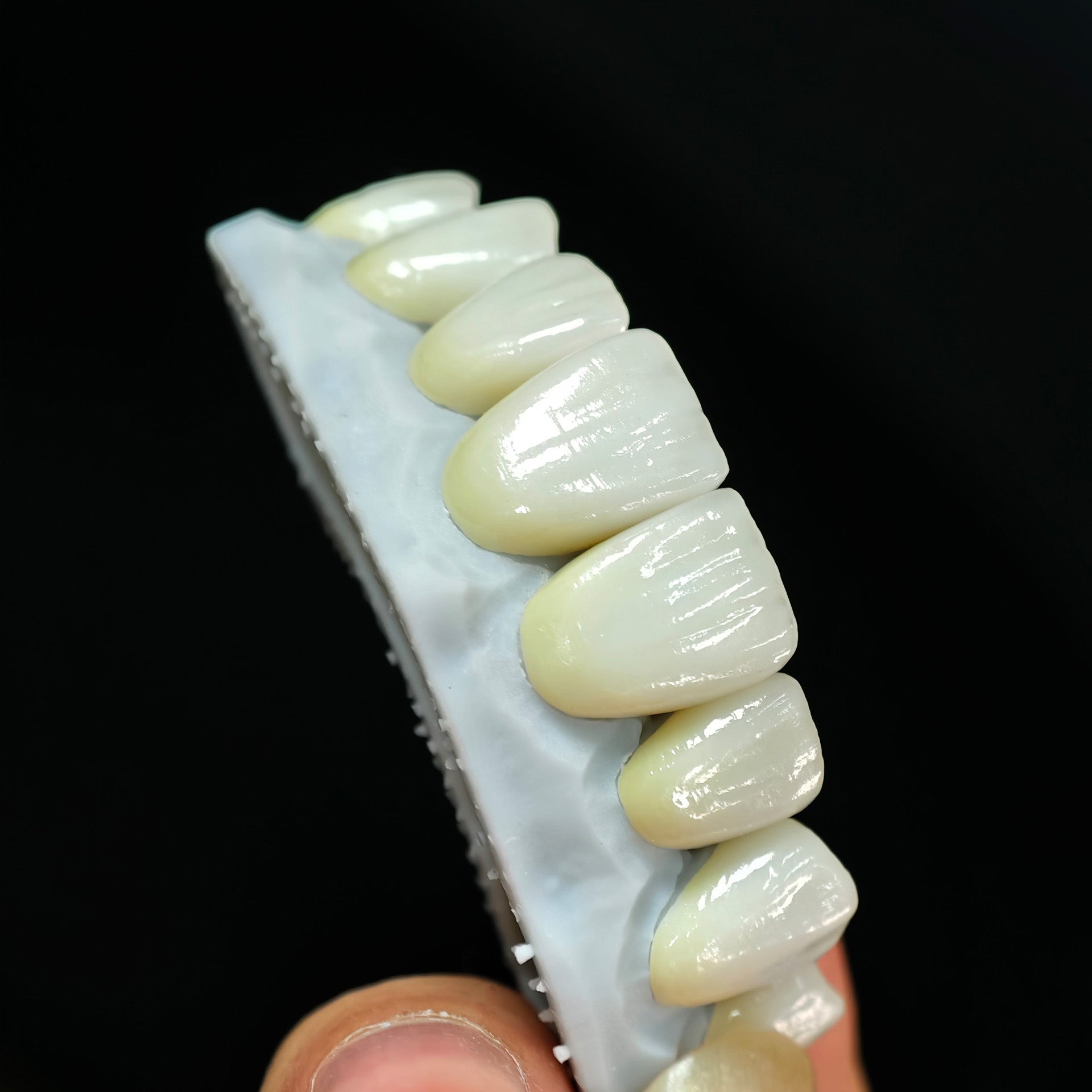 Ultra-Thin Emax Veneer. High Transparency/Translucent, Natural Shade