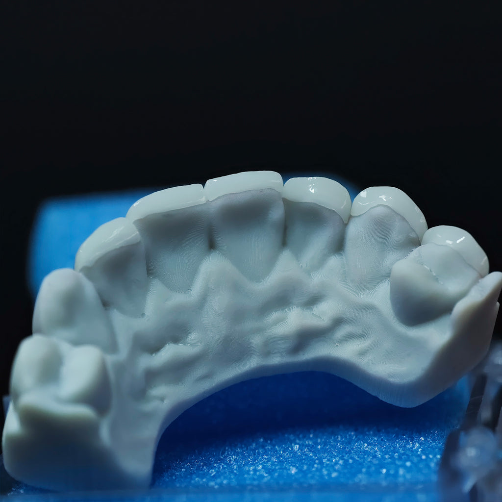 Ultra-Thin Emax Veneer. High Transparency/Translucent, Natural Shade