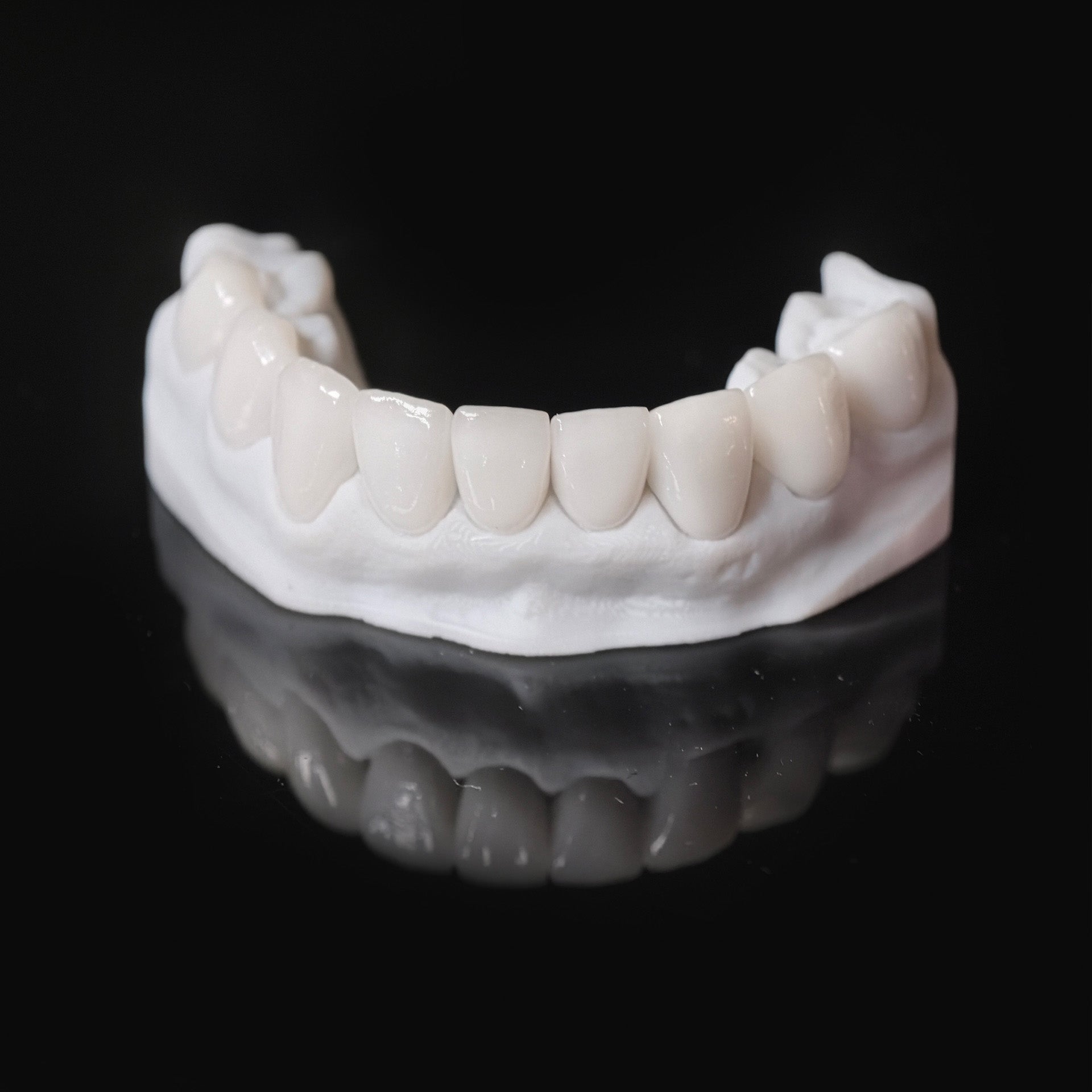 Ultra-Thin Emax Veneer. High Transparency/Translucent, Natural Shade