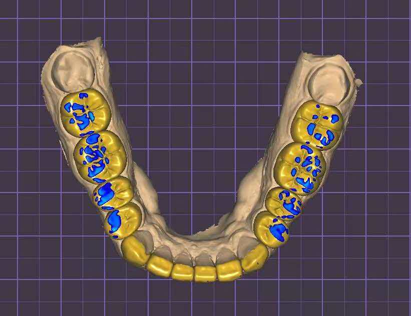 Upper And Lower Smile Design