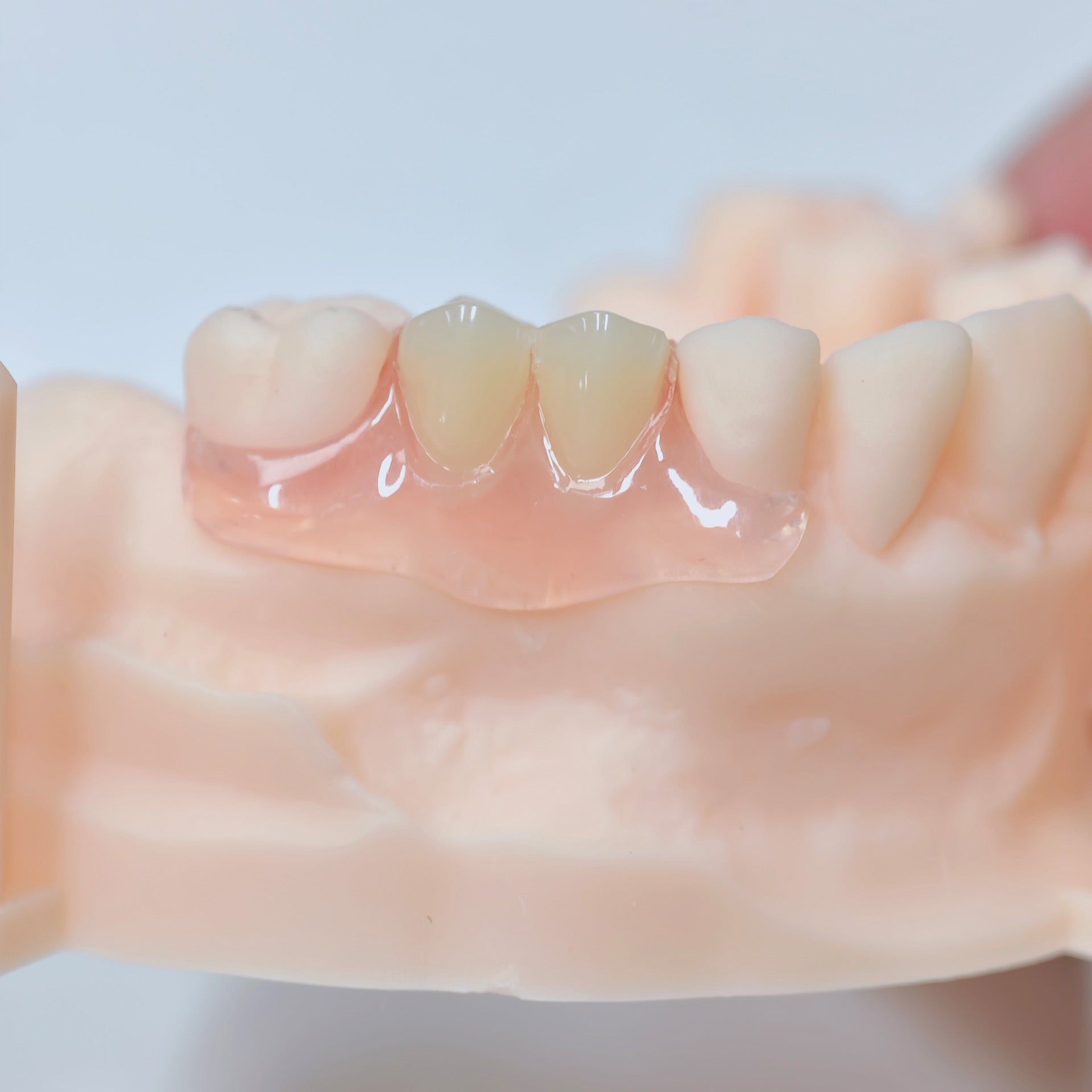 Valplast Denture Beautiful And Elastic Flexible Partial Natural Appearance