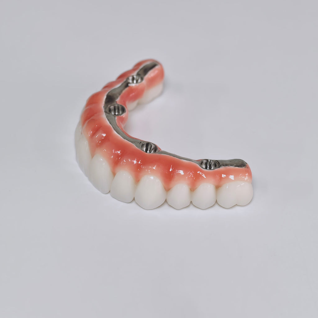 Zirconia-Enamel Hybrid Malo Bridge Aesthetic