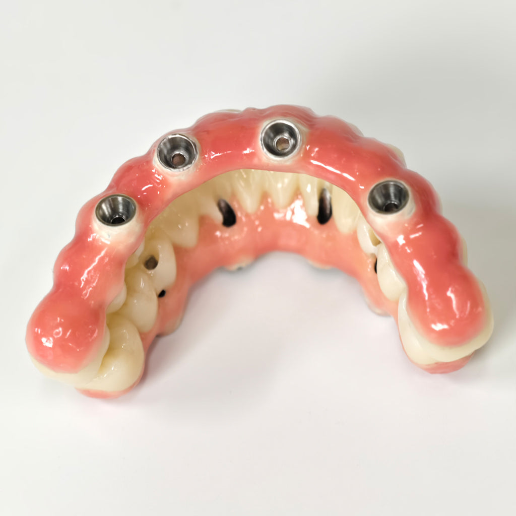 Zirconia-Enamel Hybrid Malo Bridge