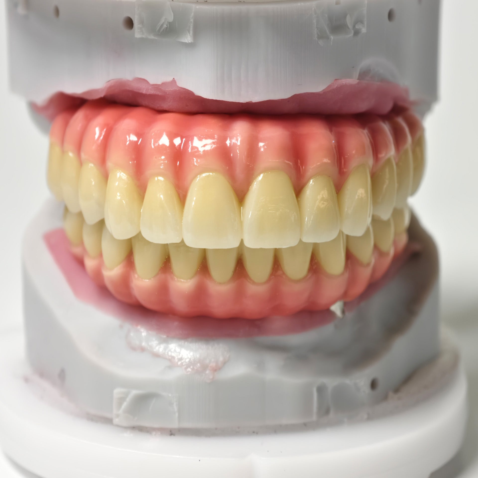 Zirconia-Enamel Hybrid Malo Bridge