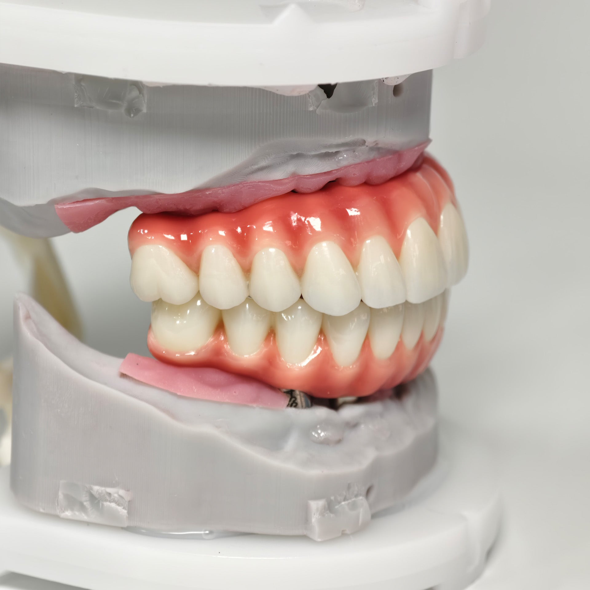 Zirconia-Enamel Hybrid Malo Bridge