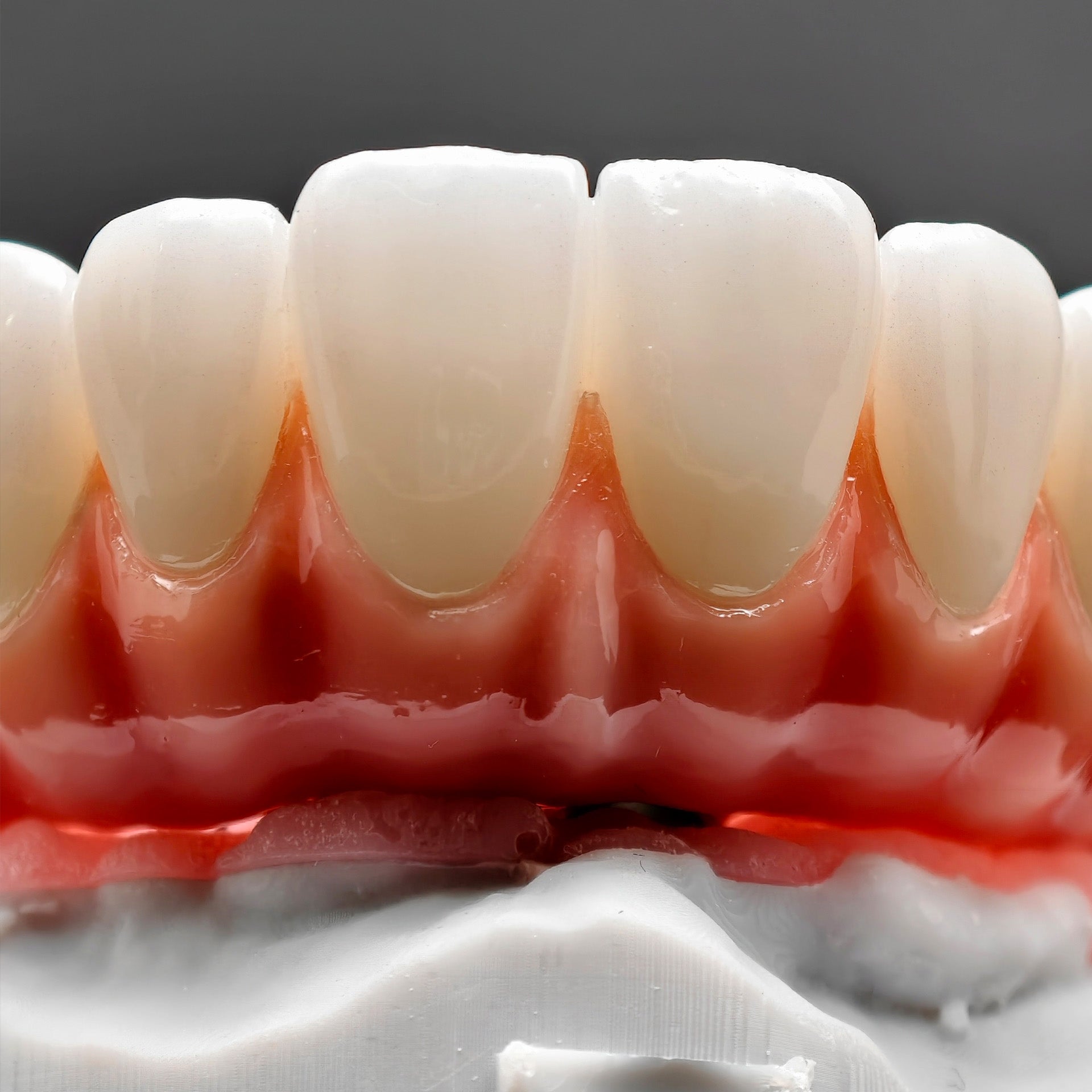 Zirconia-Enamel Hybrid Malo Bridge