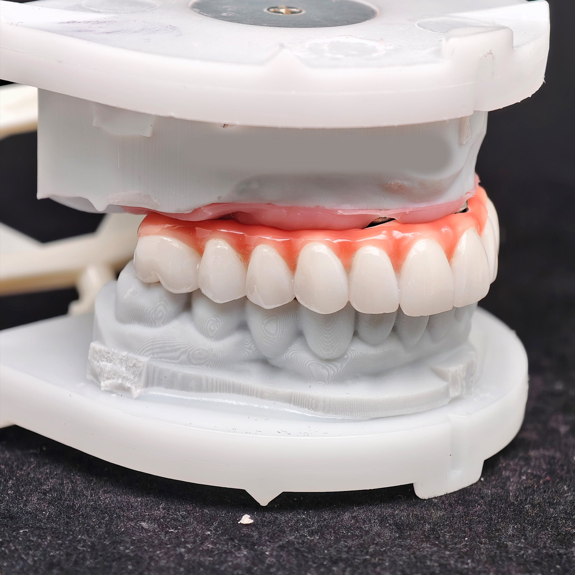 Zirconia-Enamel Hybrid Malo Bridge