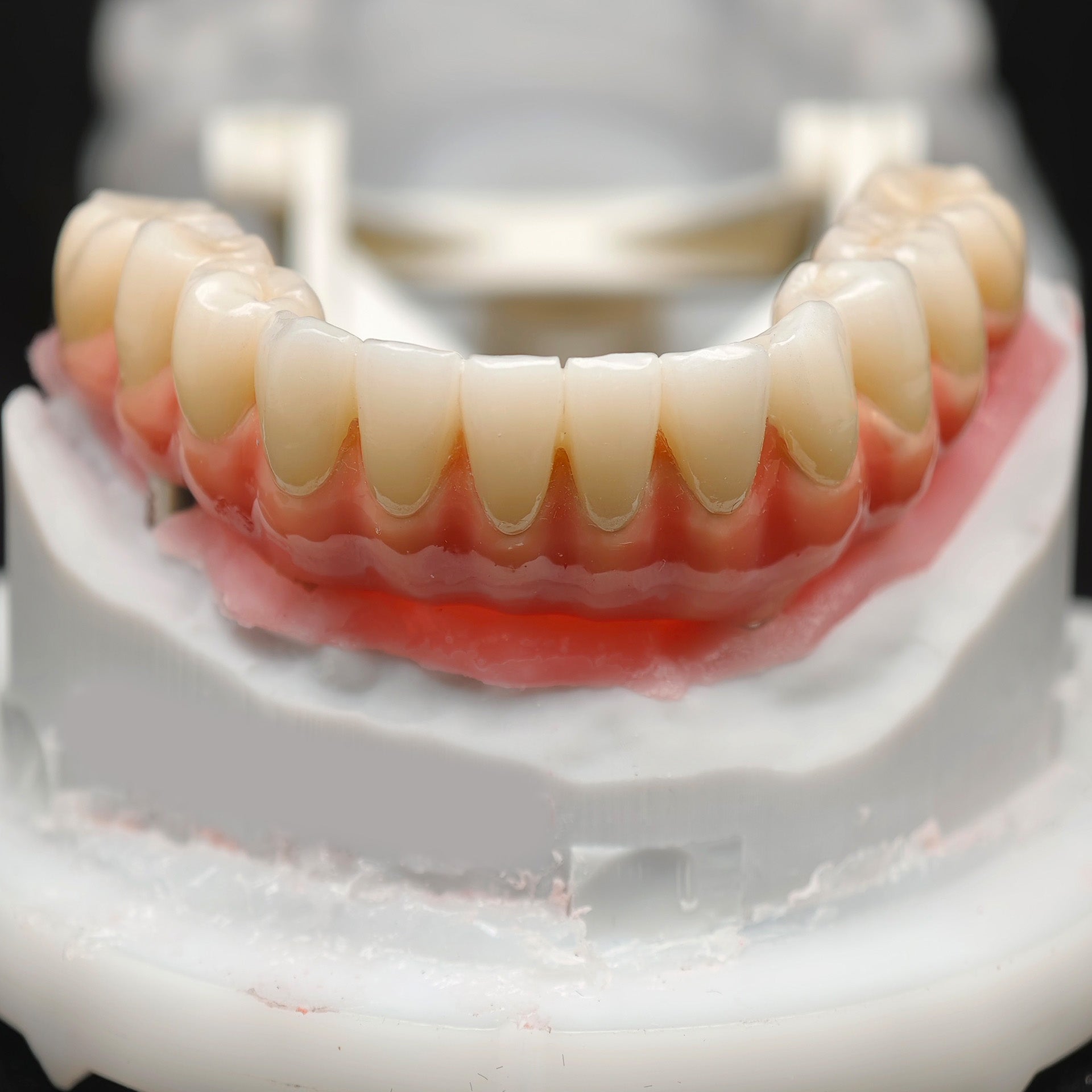 Zirconia-Enamel Hybrid Malo Bridge