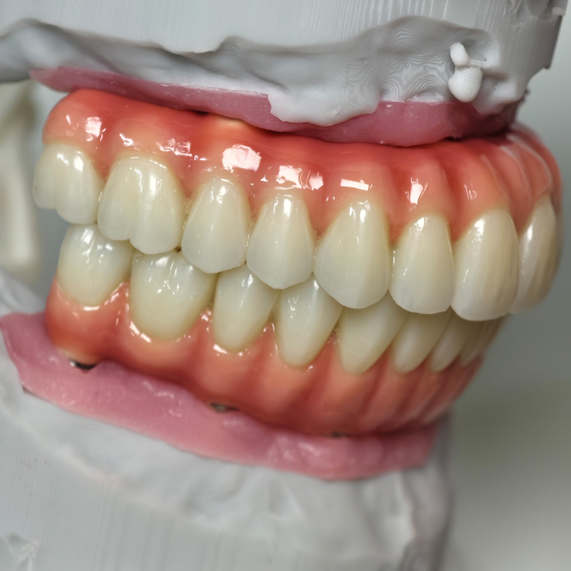 Zirconia-Enamel Hybrid Malo Bridge