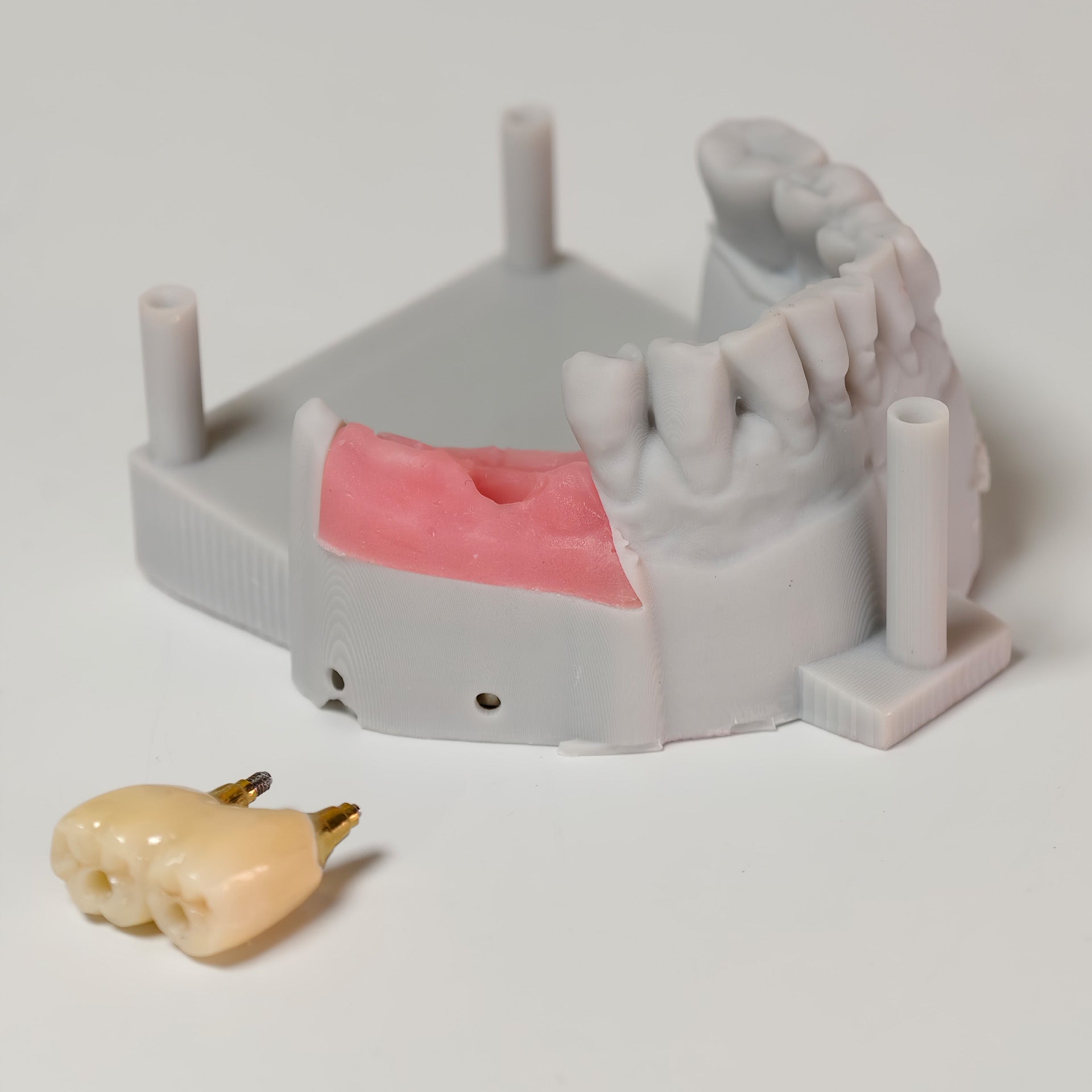 Zirconia Bridge With Screw Retained