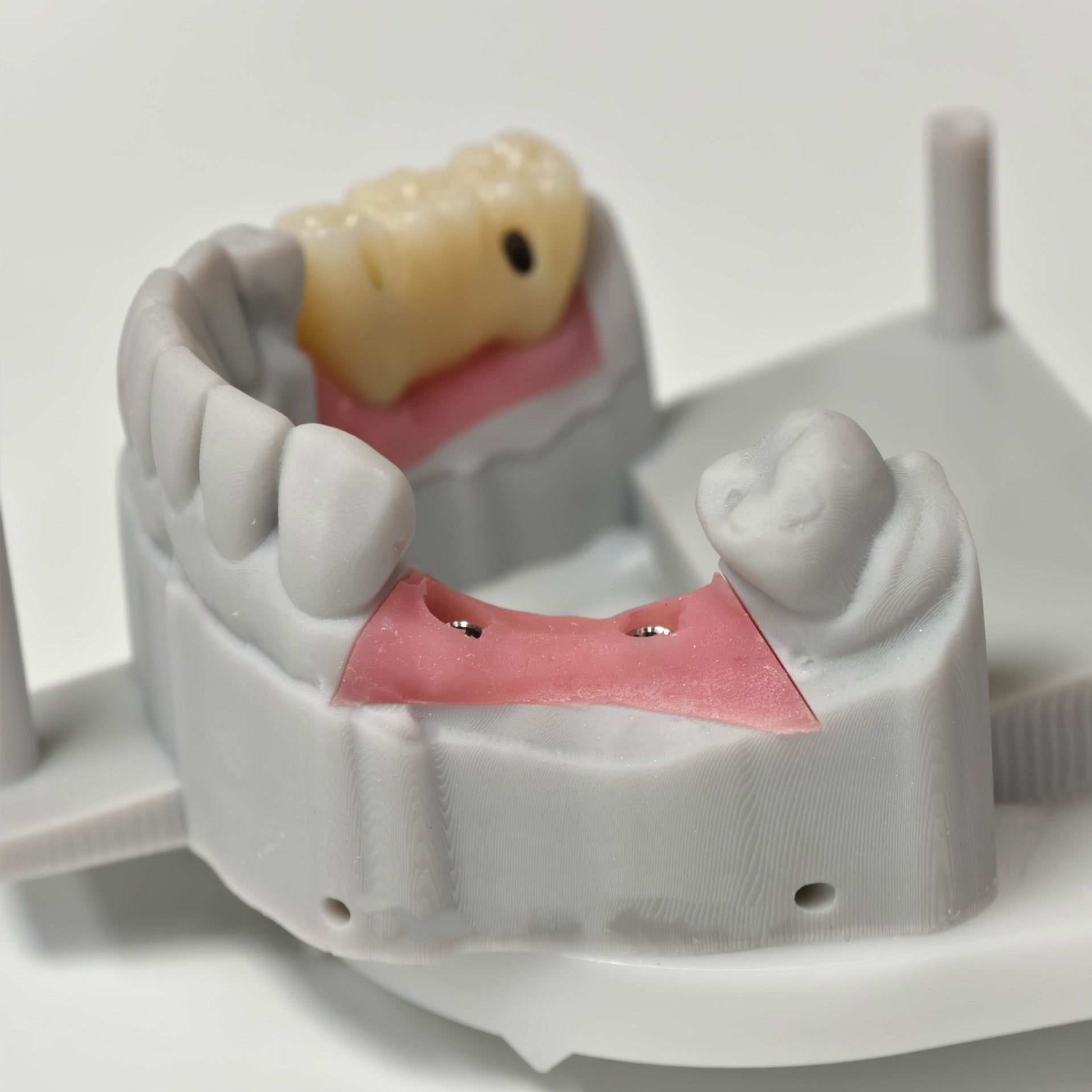 Zirconia Bridges With Screw Retained