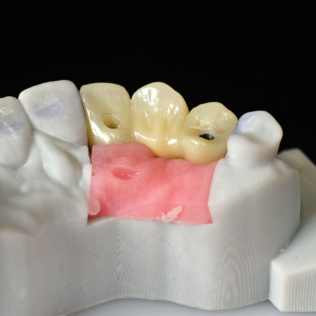 Zirconia Bridge With Ti-Base Screw Retained