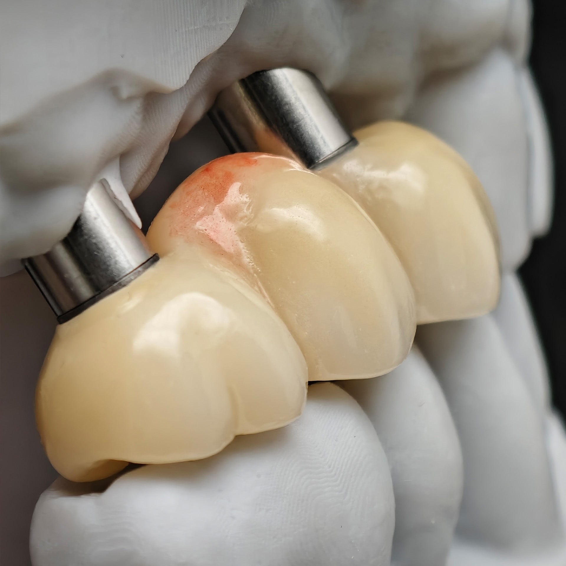 Zirconia Bridge With Ti-Base Screw Retained