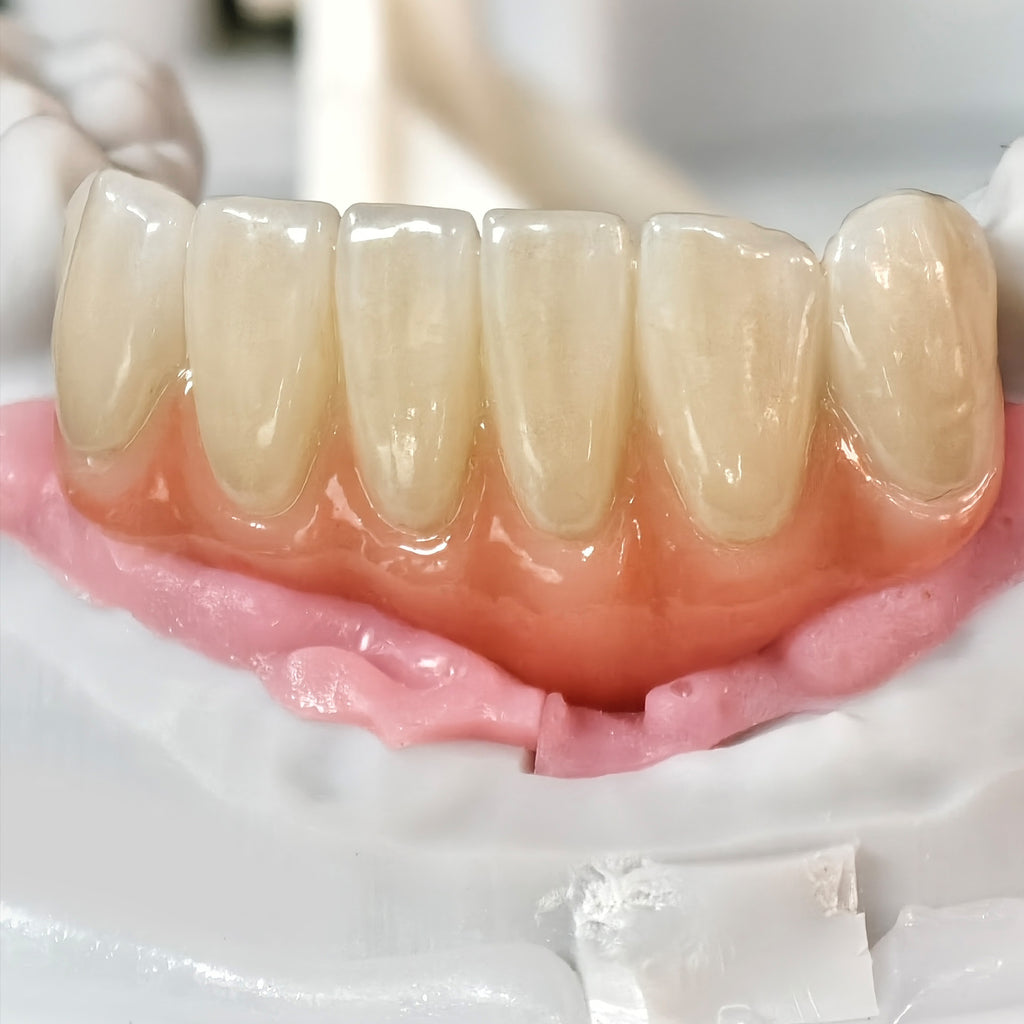 Zirconia Bridge With Ti-Base Screw Retained