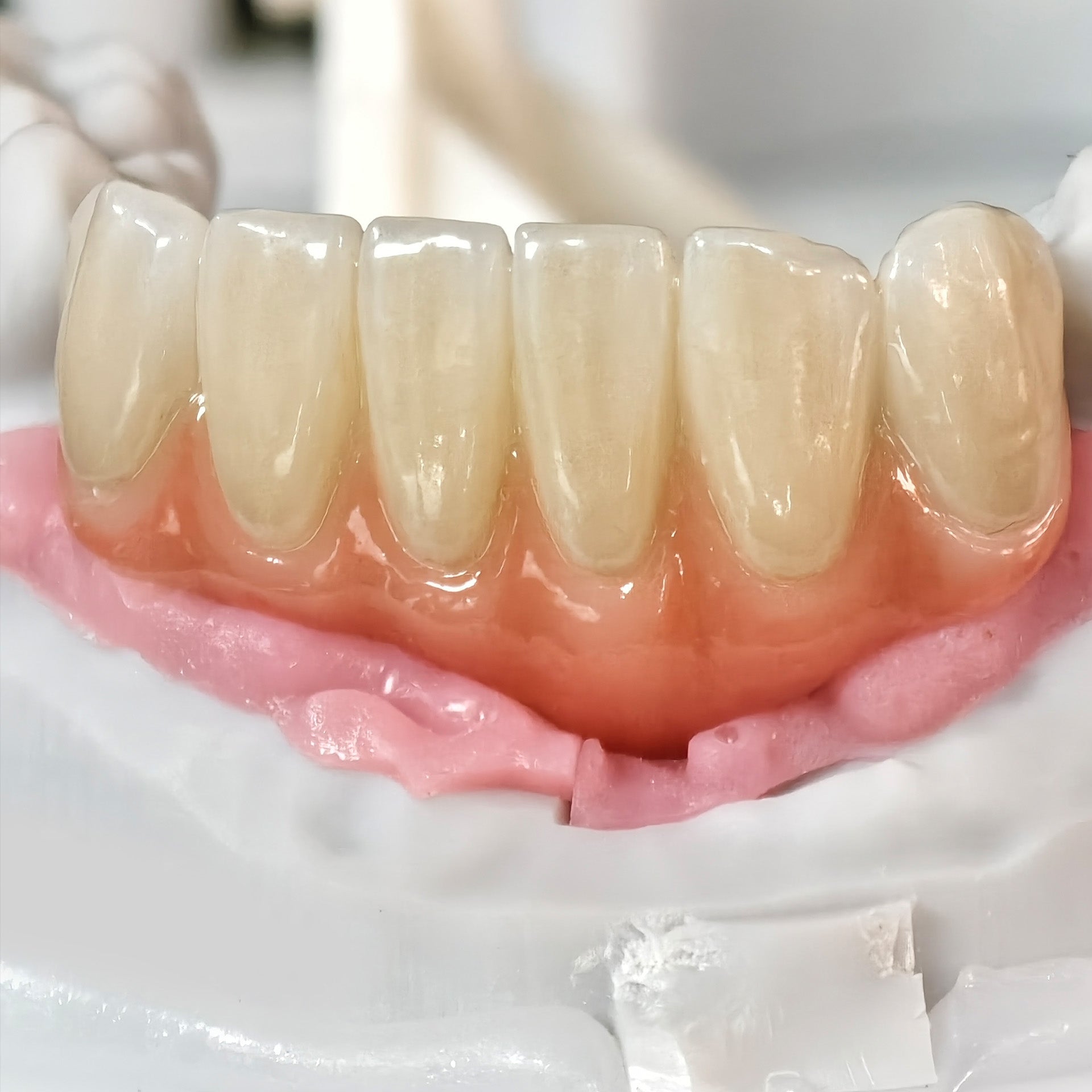 Zirconia Bridge With Ti-Base Screw Retained