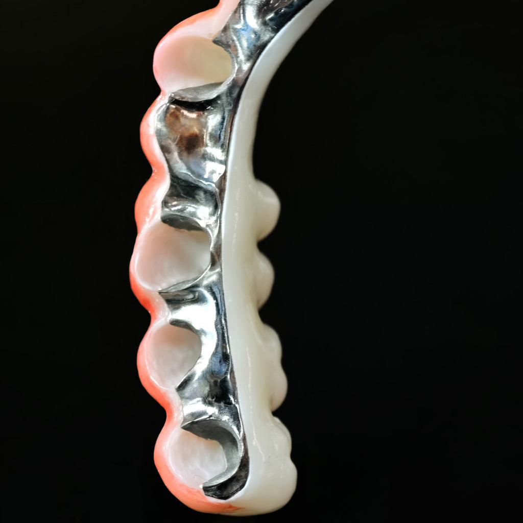 Zirconia Bridge With Cement Retained And Titanium Bar
