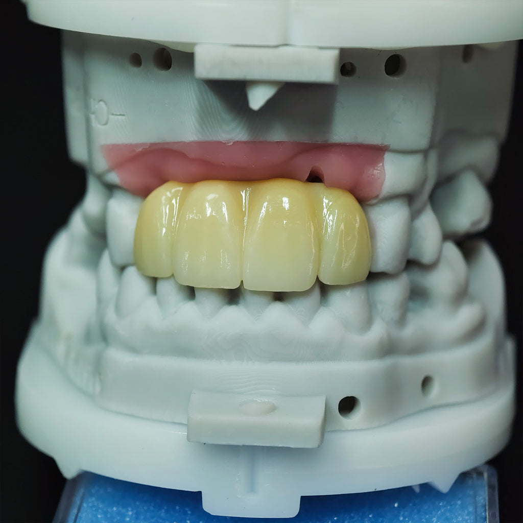 Zirconia Bridge With Screw Retained