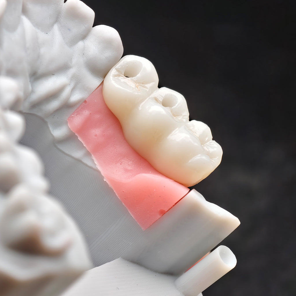 Zirconia Bridge With Screw Retained