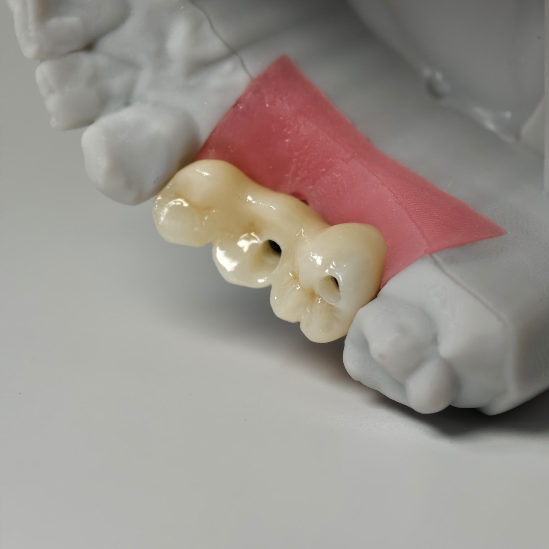 Zirconia Bridgewith Screw Retained