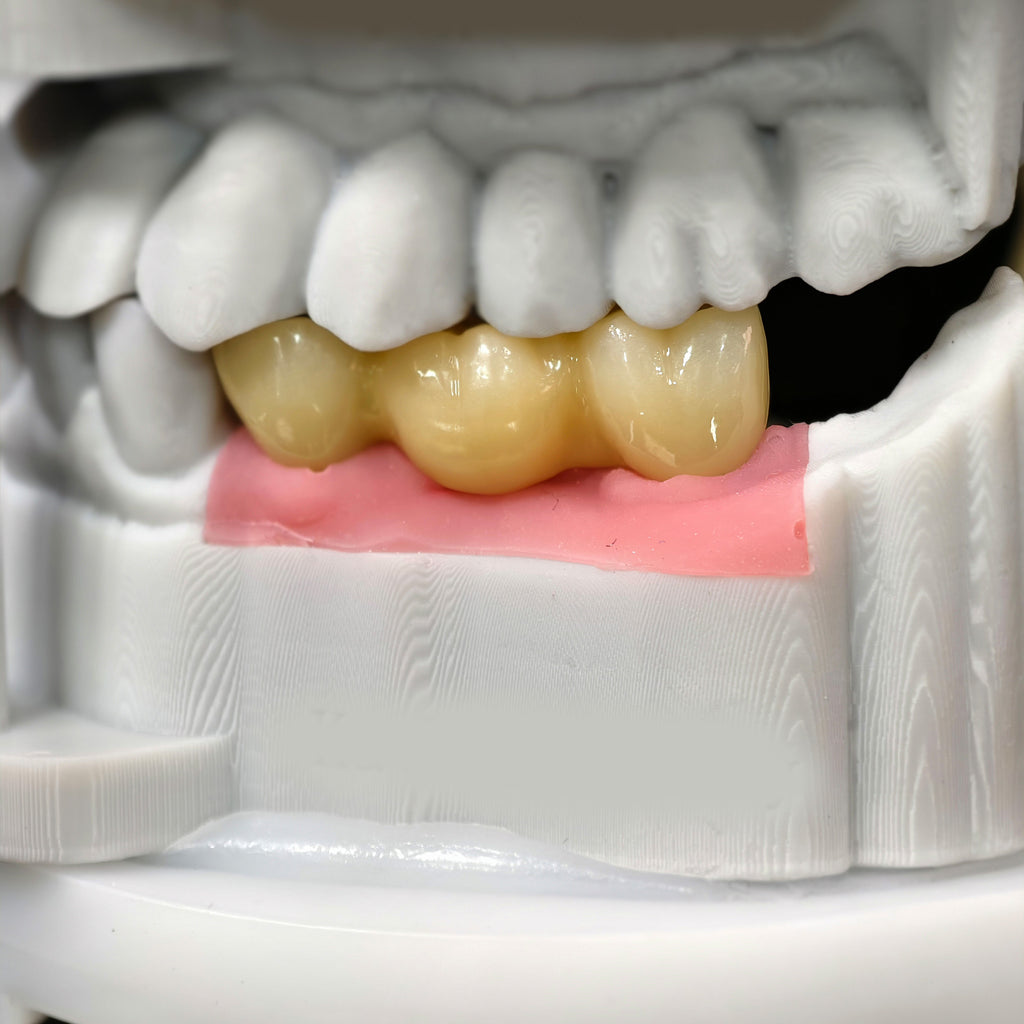Zirconia Bridge With Screw Retained