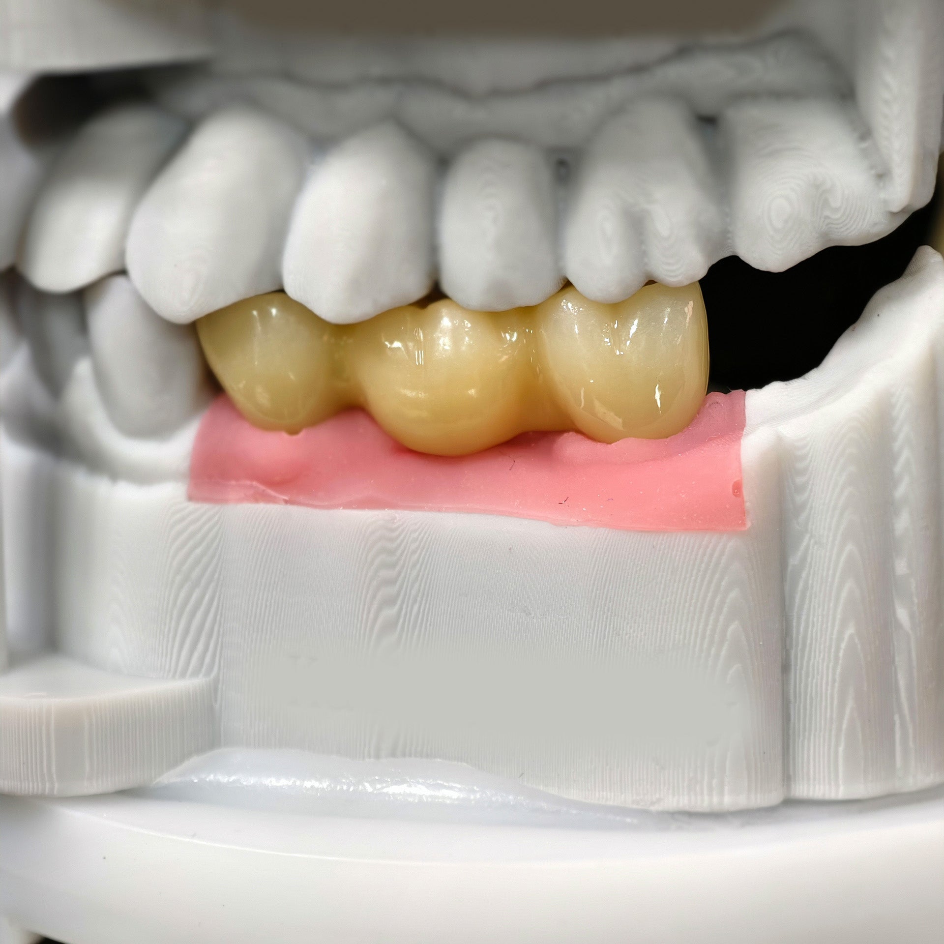 Zirconia Bridge With Screw Retained
