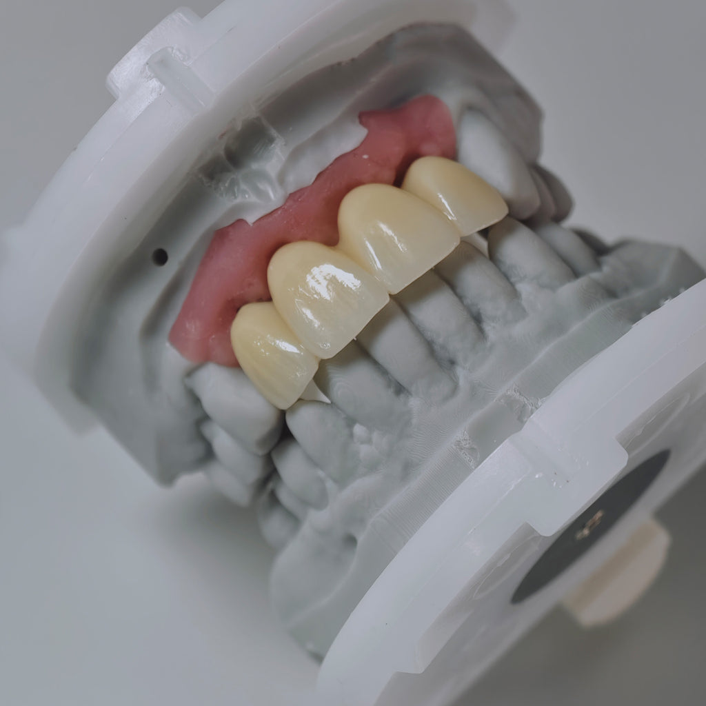 Zirconia Bridge With Screw Retained