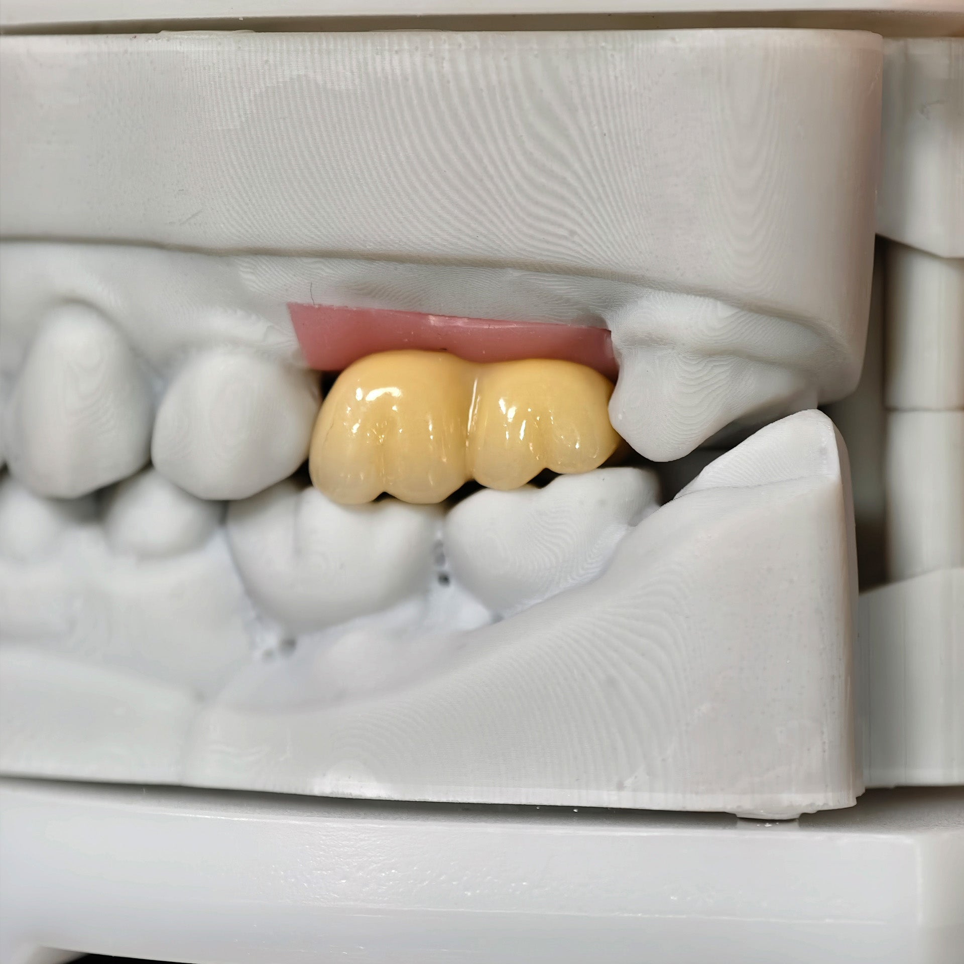 Zirconia Bridge With Screw Retained