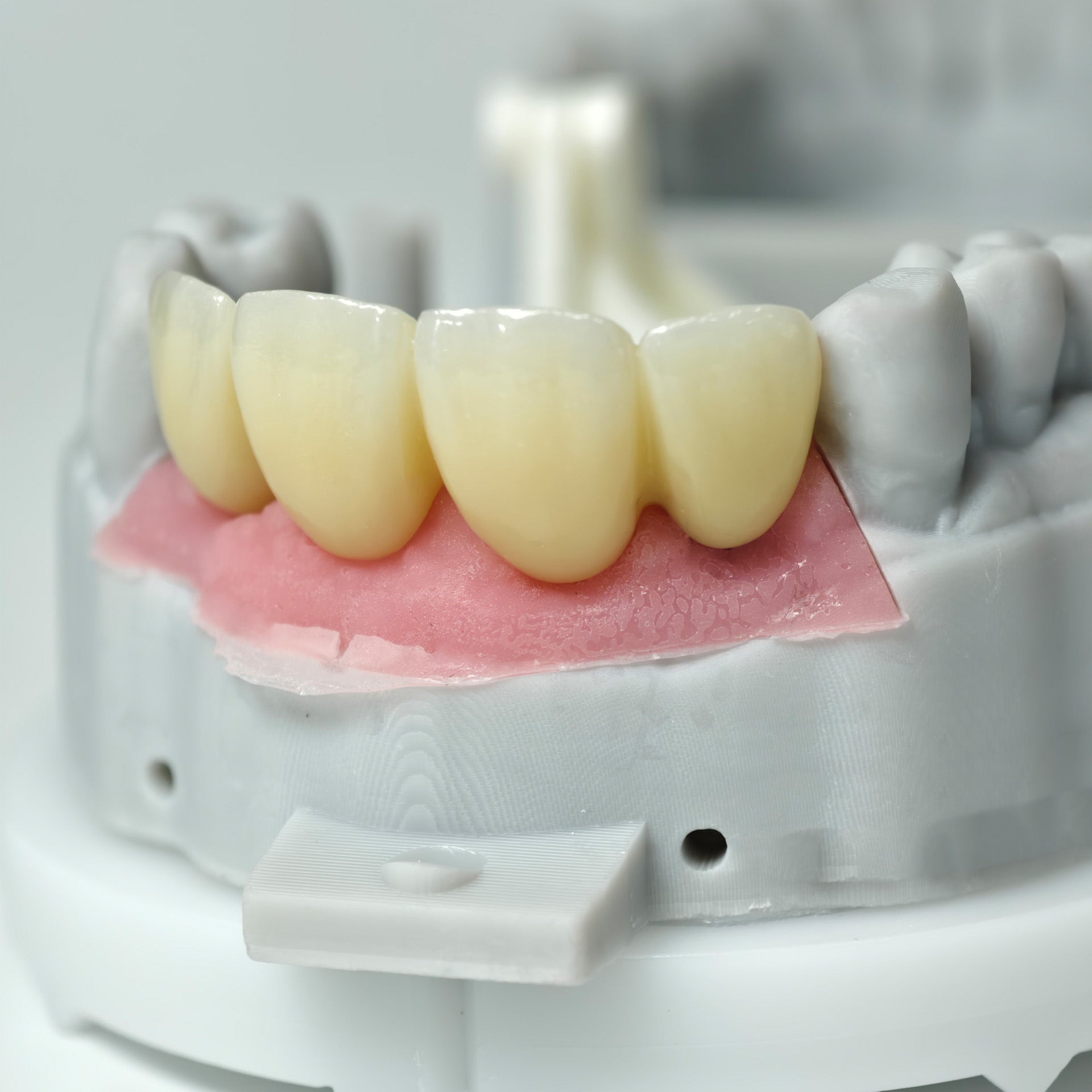 Zirconia Bridge With Screw Retained