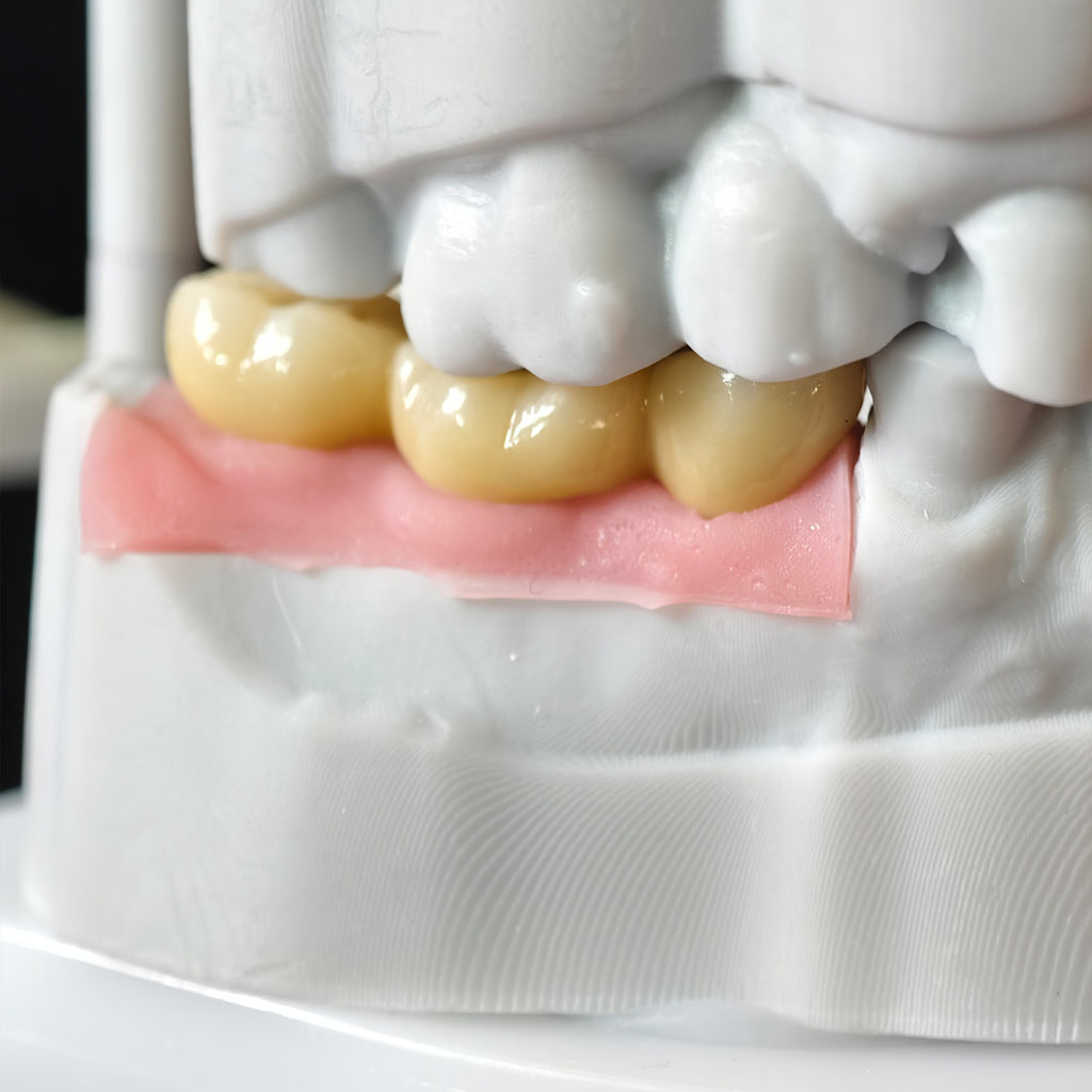 Zirconia Bridge With Screw Retained Gold Plating