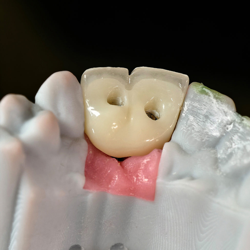 Zirconia Bridge With Ti-Base Bautment