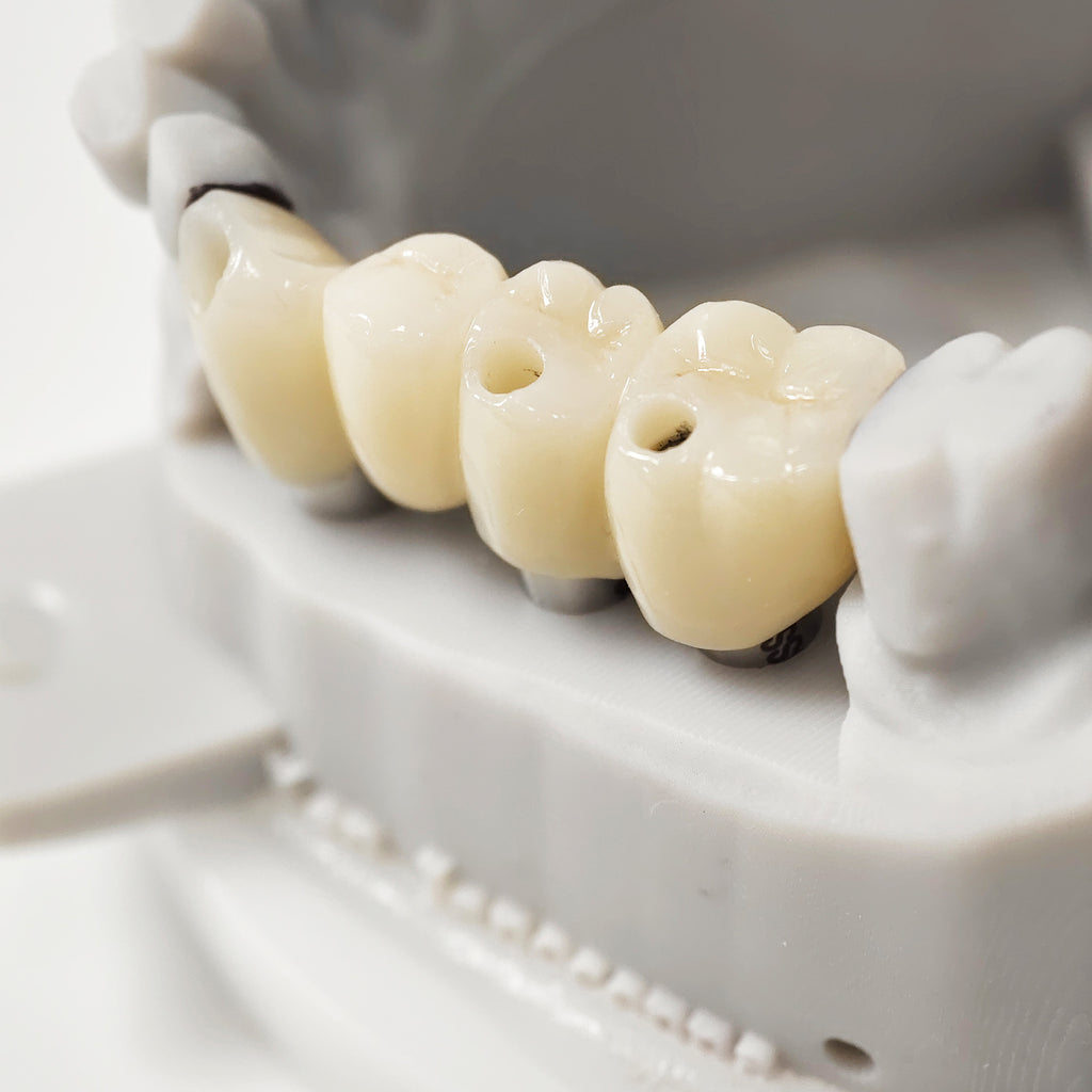 Zirconia Bridge With Ti-Base Screw Retained