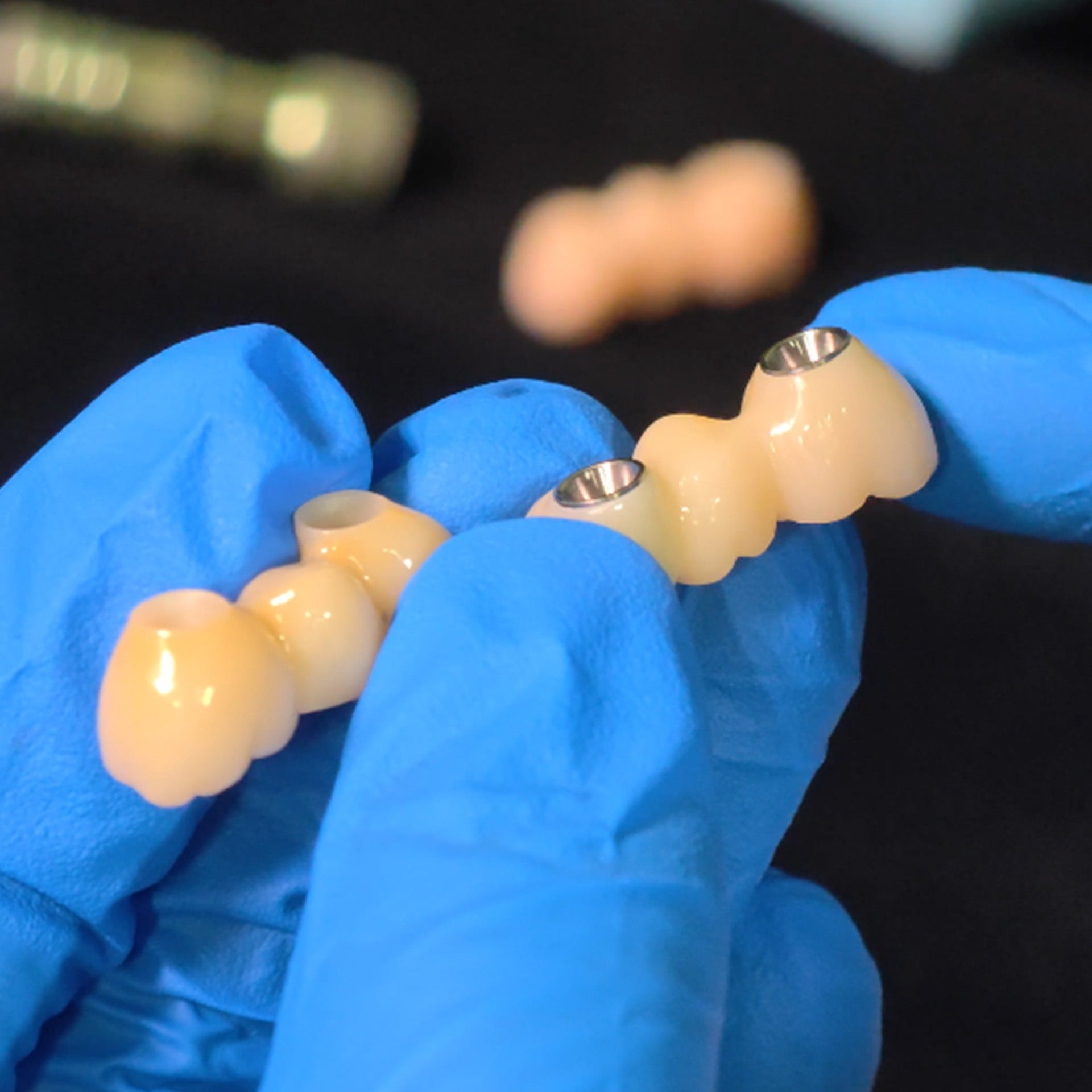 Zirconia Bridge With Ti-Base Screw Retained