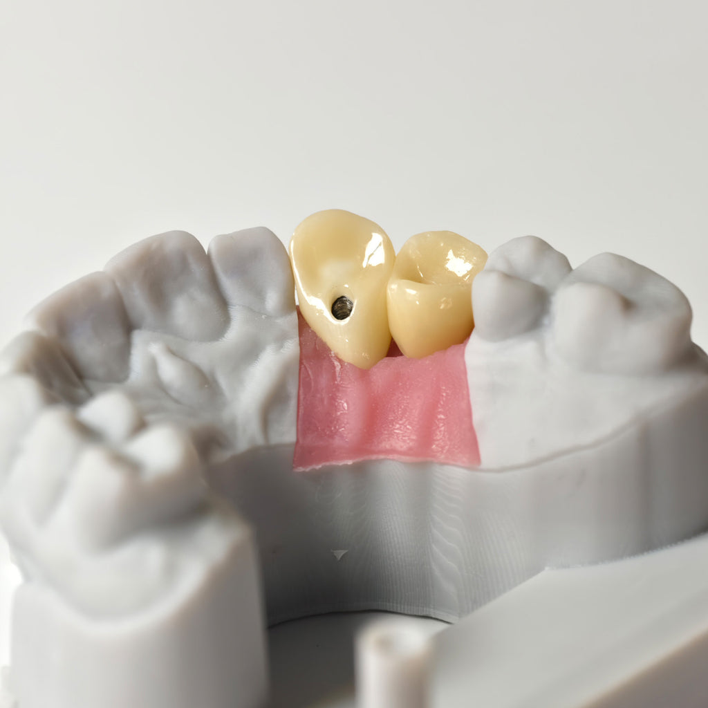 Zirconia Crowns With Gold-Plated Abutment