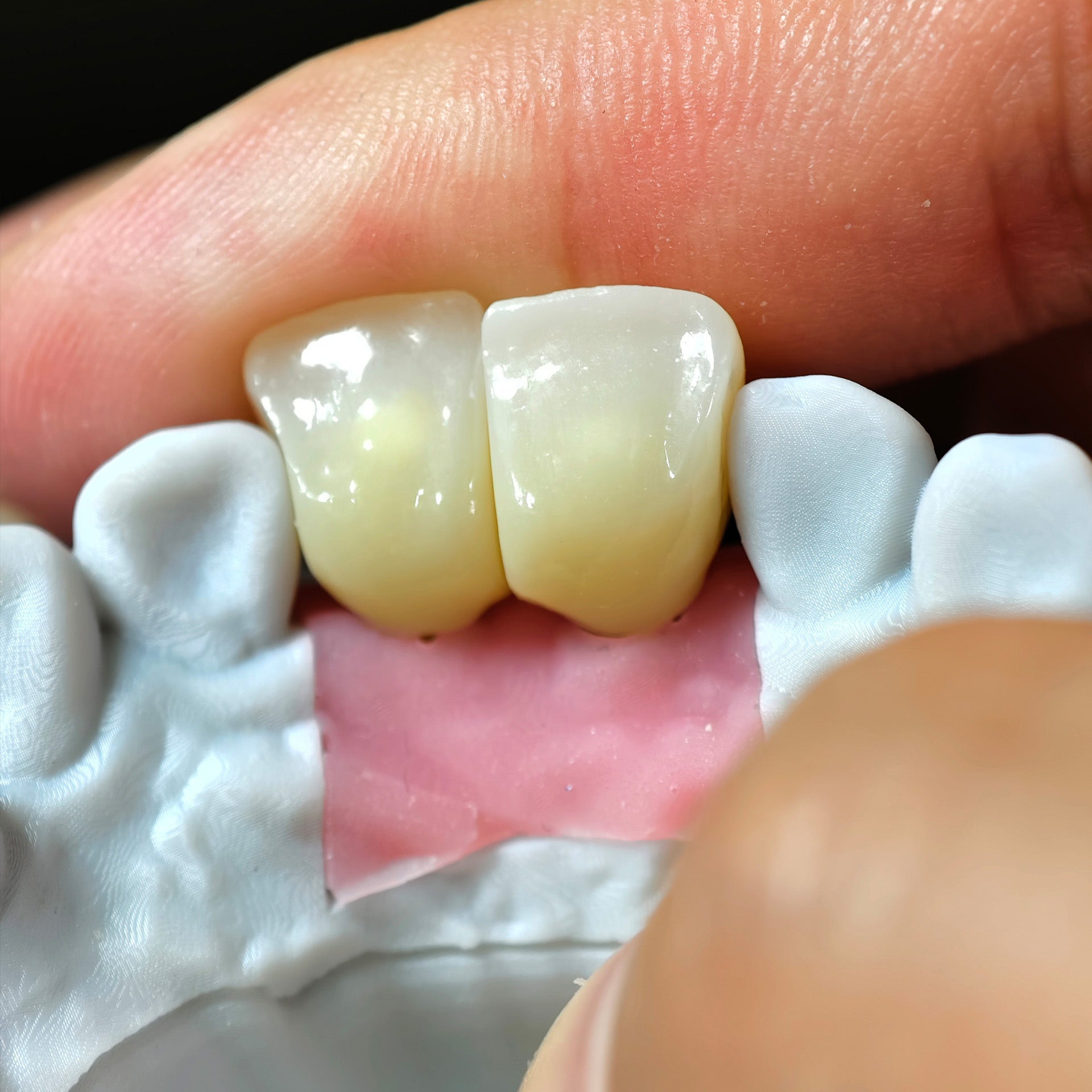 Zirconia Crowns With Gold-Plated Abutment And Implant Seating Guide
