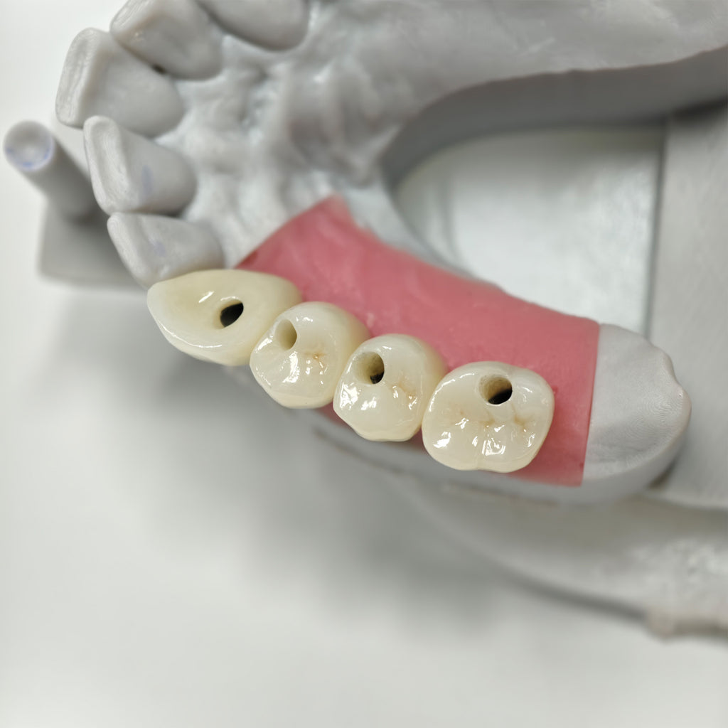 Zirconia Crowns With Screw Retained